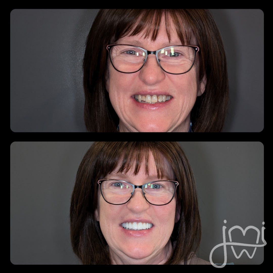 Side-by-side comparison shows a woman's teeth before (top) and after (bottom) dental work. Her glasses and hairstyle remain the same.