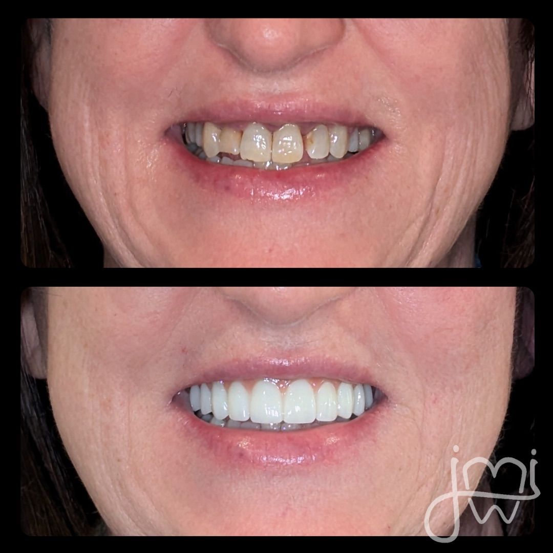 Side-by-side comparison of a person's teeth before and after dental work, showing a transformation to a brighter smile.