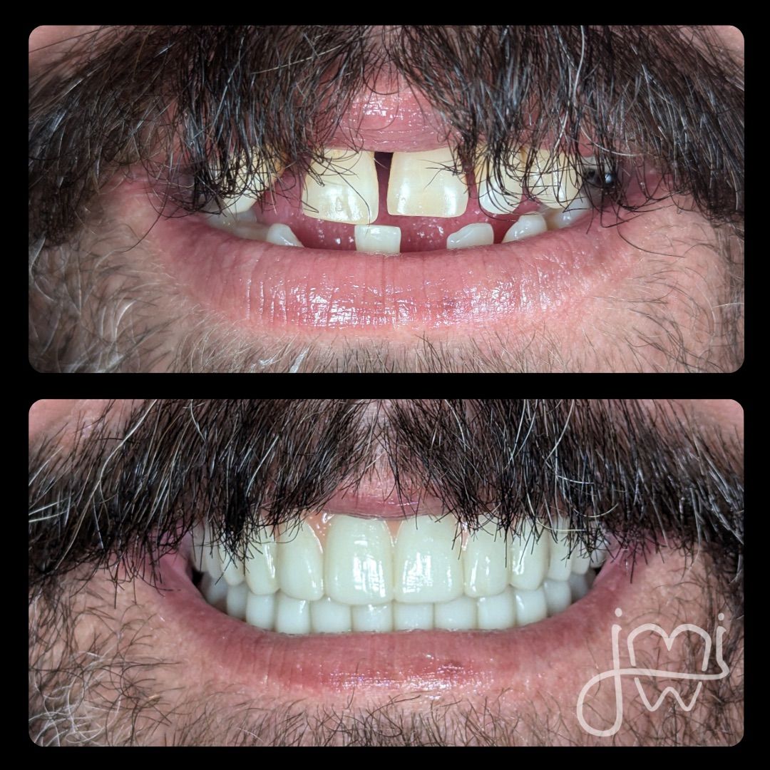 Before and after dental work: Man's smile with missing, discolored teeth transforms to a full, bright smile.