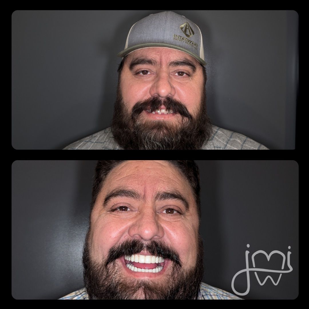 Before-and-after of a man's smile. Top: teeth before. Bottom: a bright, new smile.