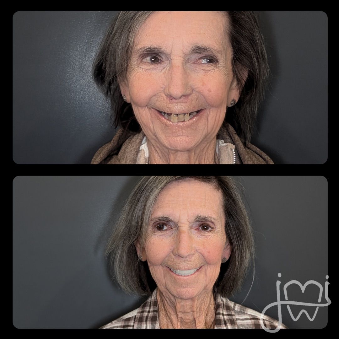 Top: Woman with missing and discolored teeth. Bottom: Woman smiling with new, white teeth. Gray background.