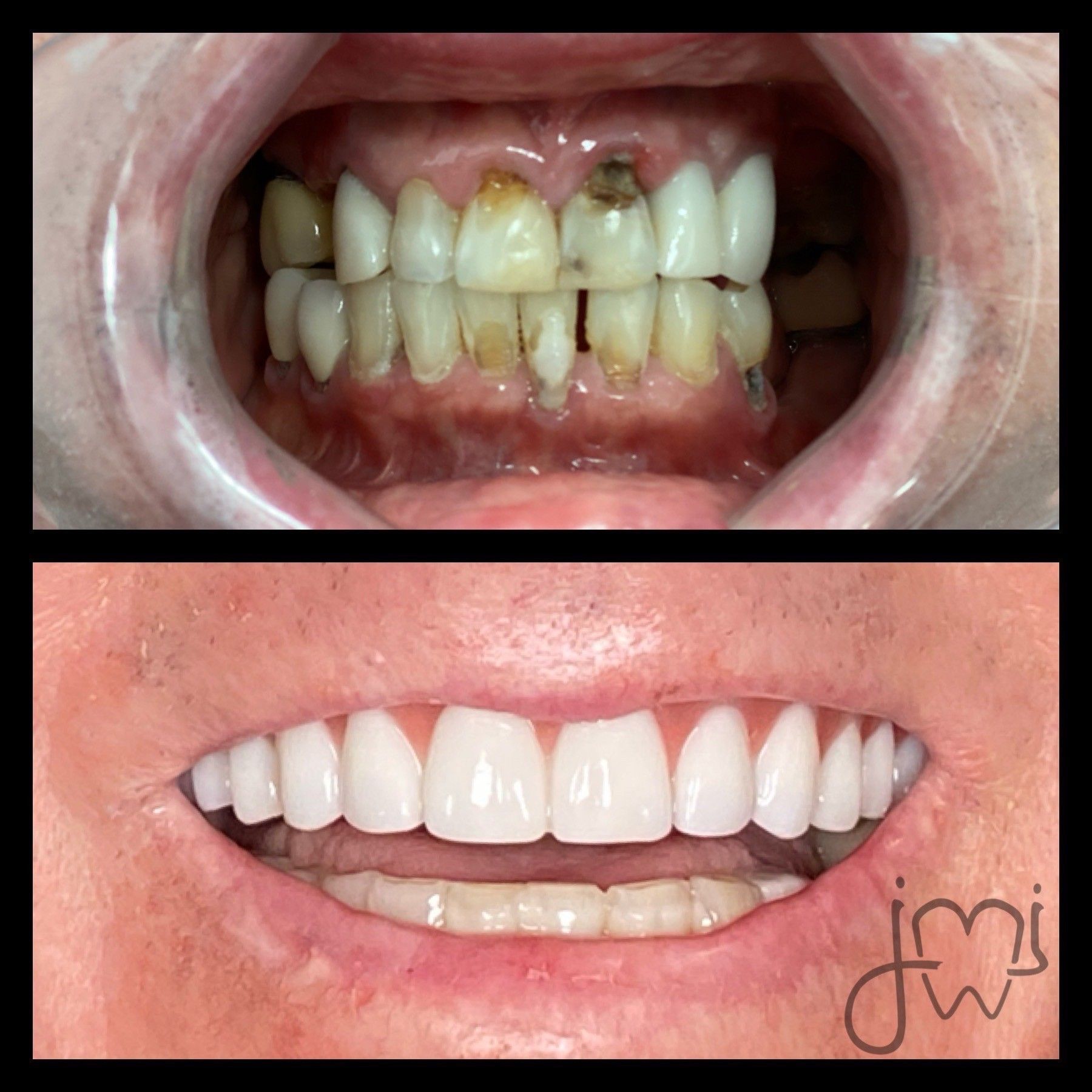 A before and after picture of a person 's teeth
