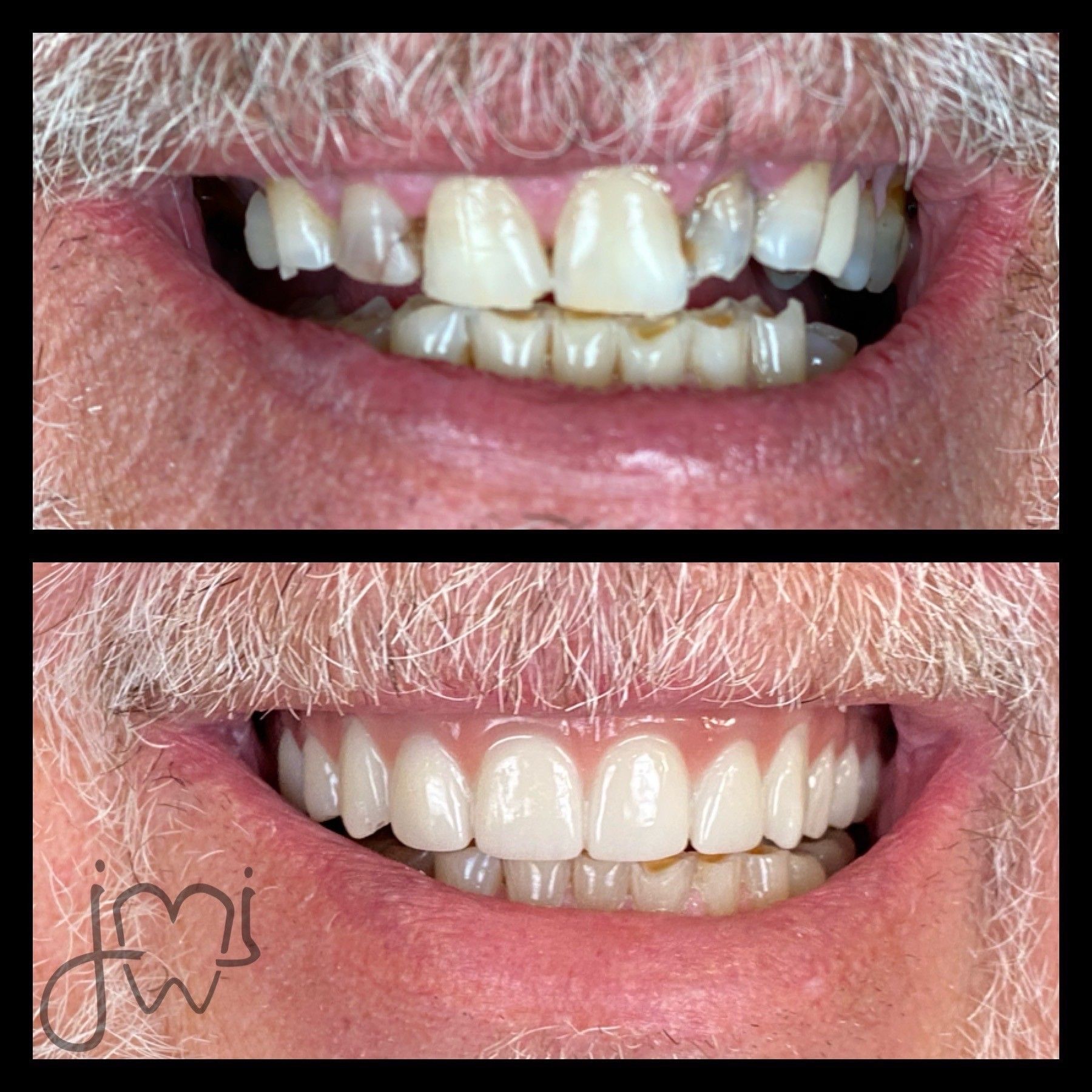 A before and after photo of a man 's teeth.