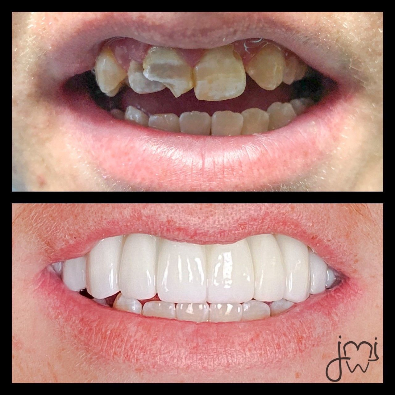 A before and after picture of a person 's teeth
