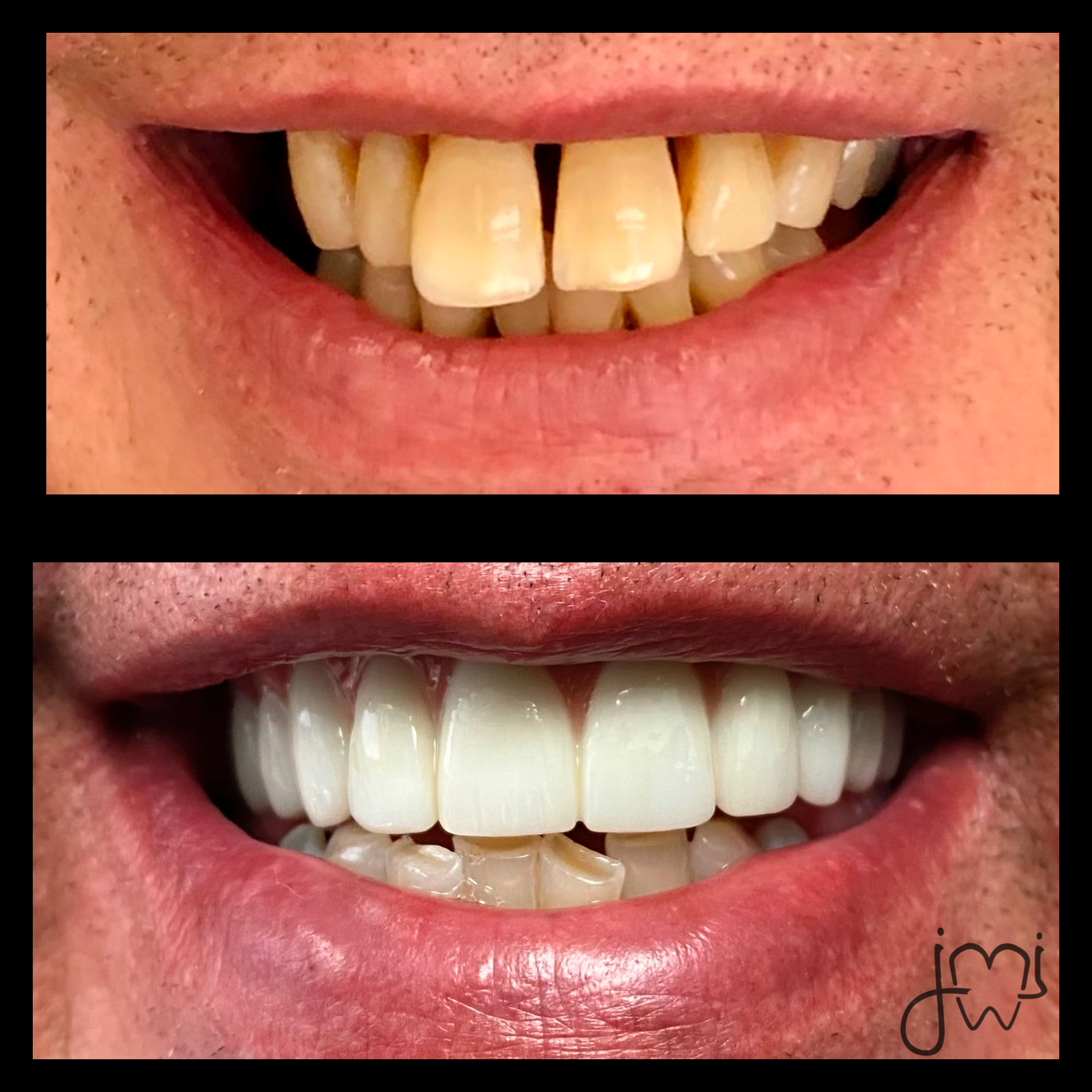 A before and after picture of a person 's teeth
