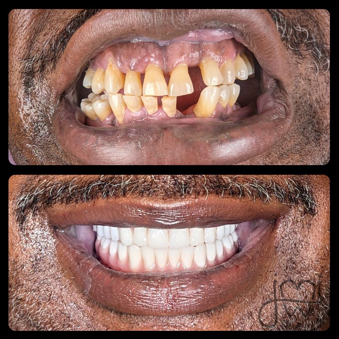 A before and after photo of a man 's teeth.