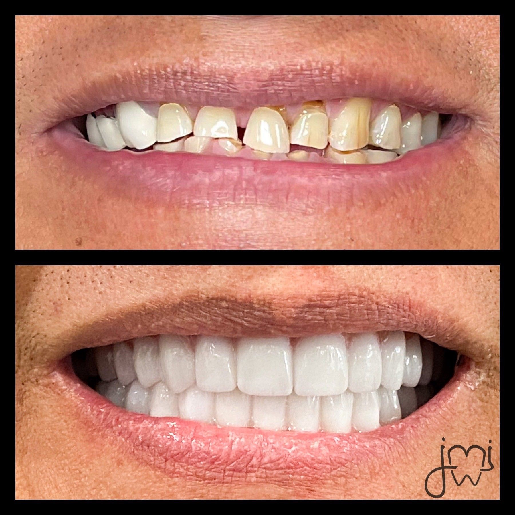 A before and after photo of a person 's teeth.