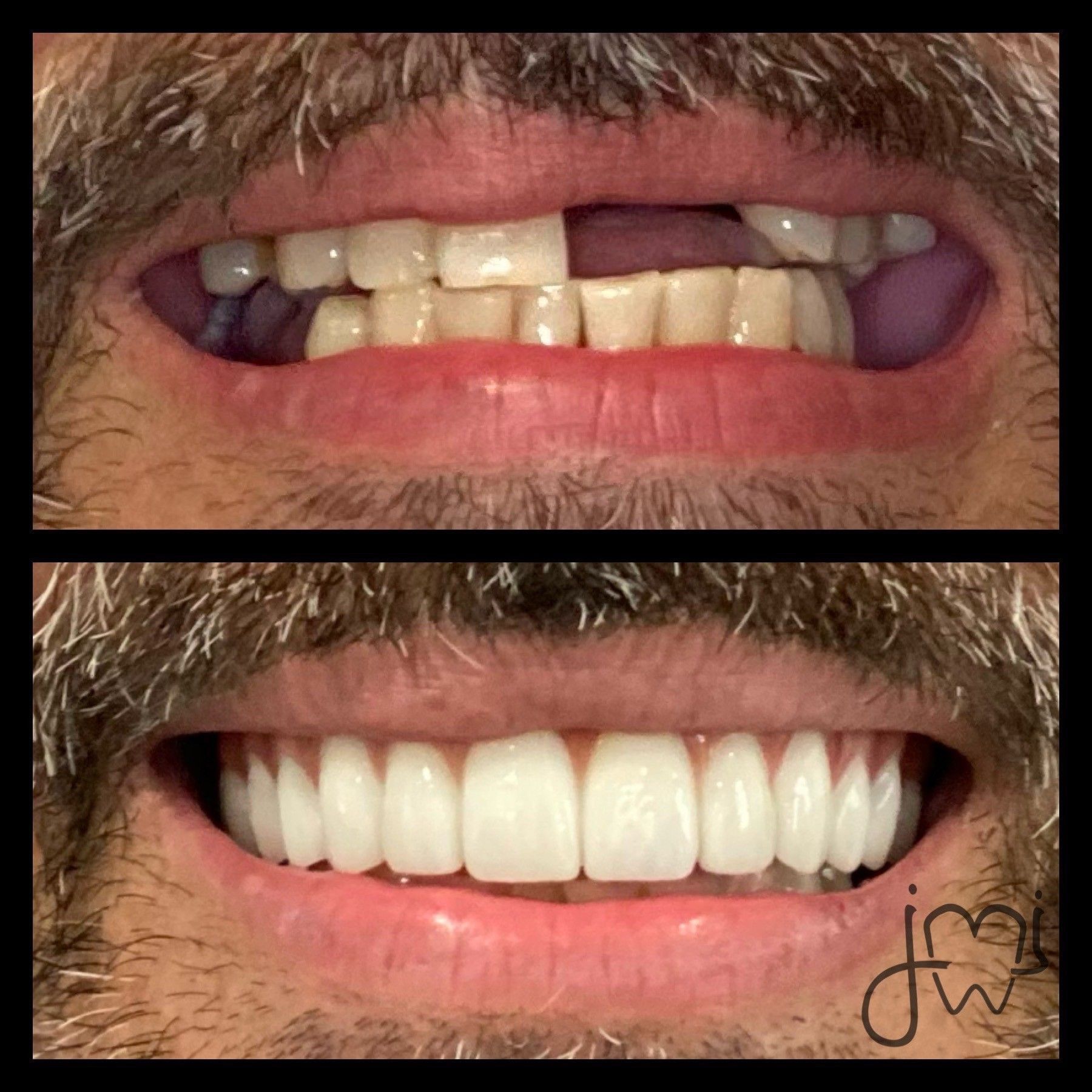 A man with a beard has a before and after picture of his teeth.