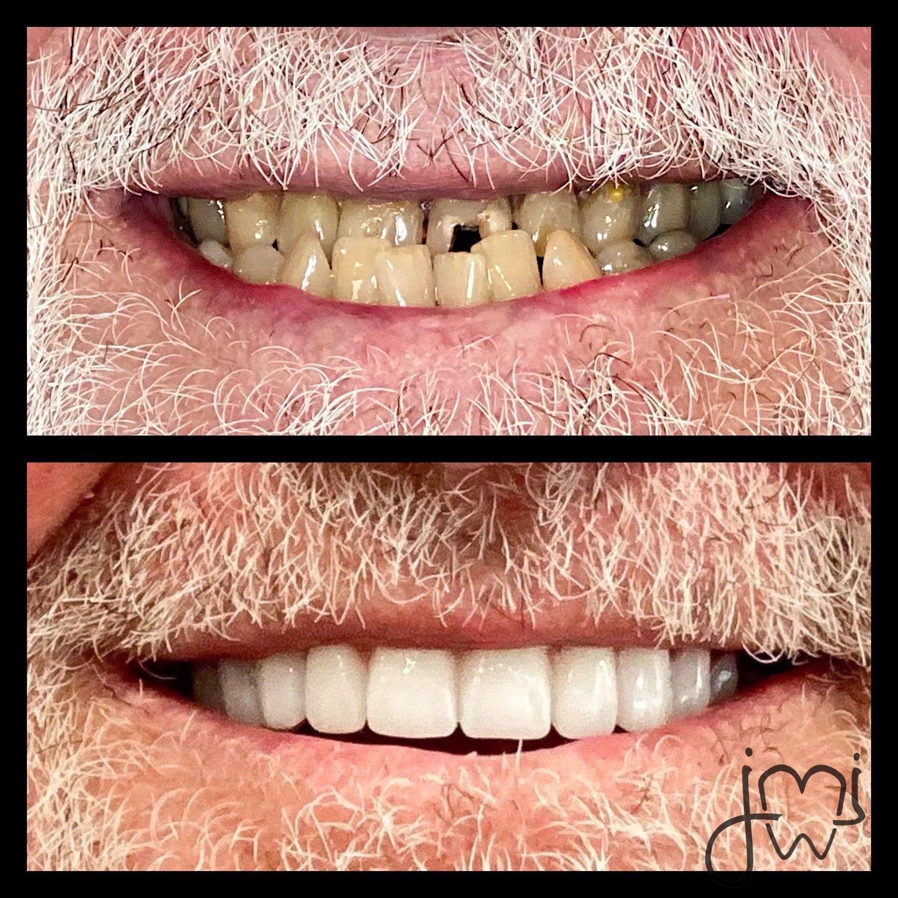 A man with a beard has a before and after picture of his teeth.