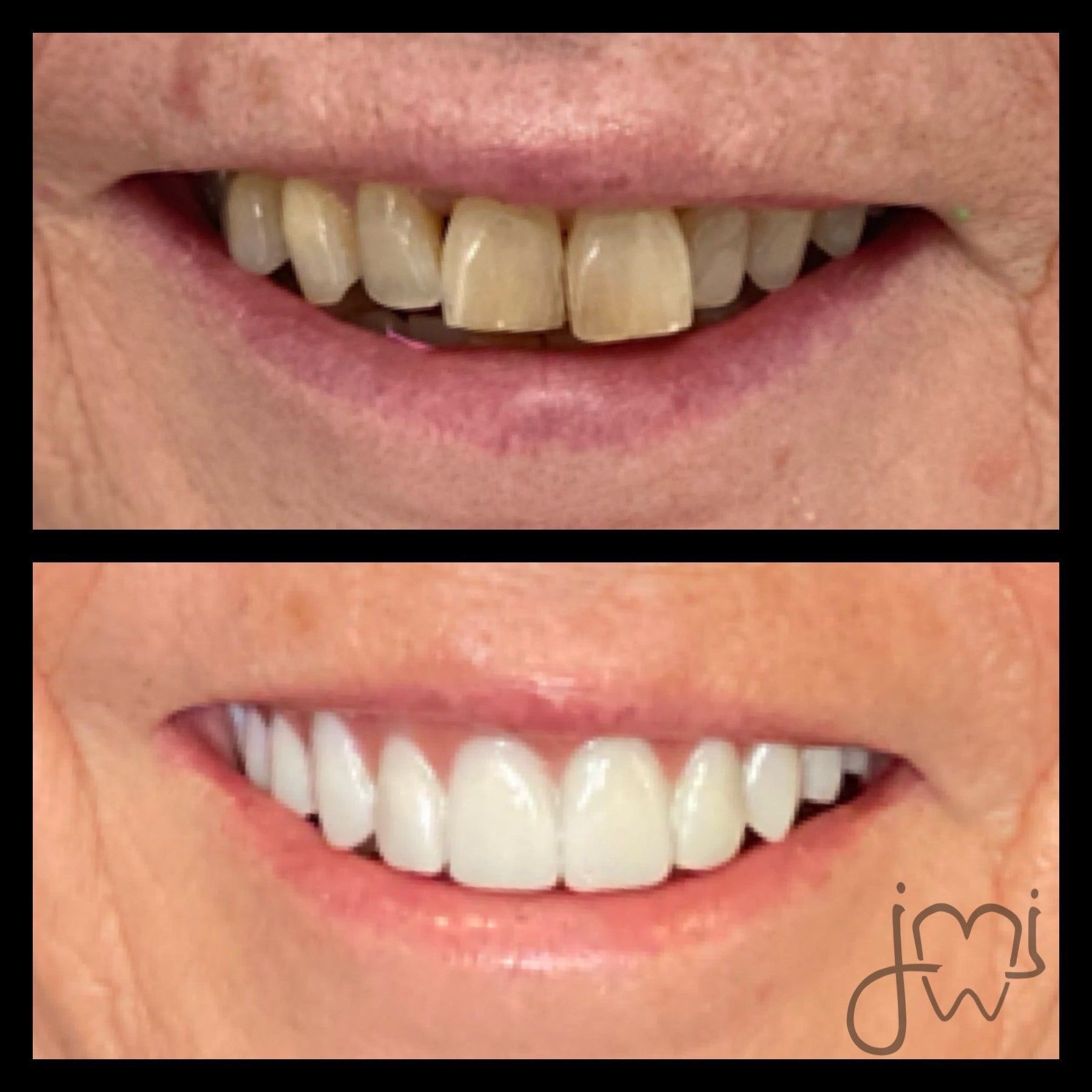 A before and after photo of a woman 's smile