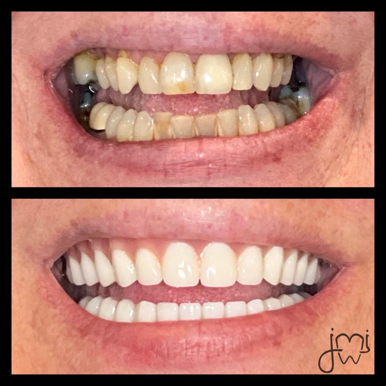 A before and after picture of a woman 's teeth