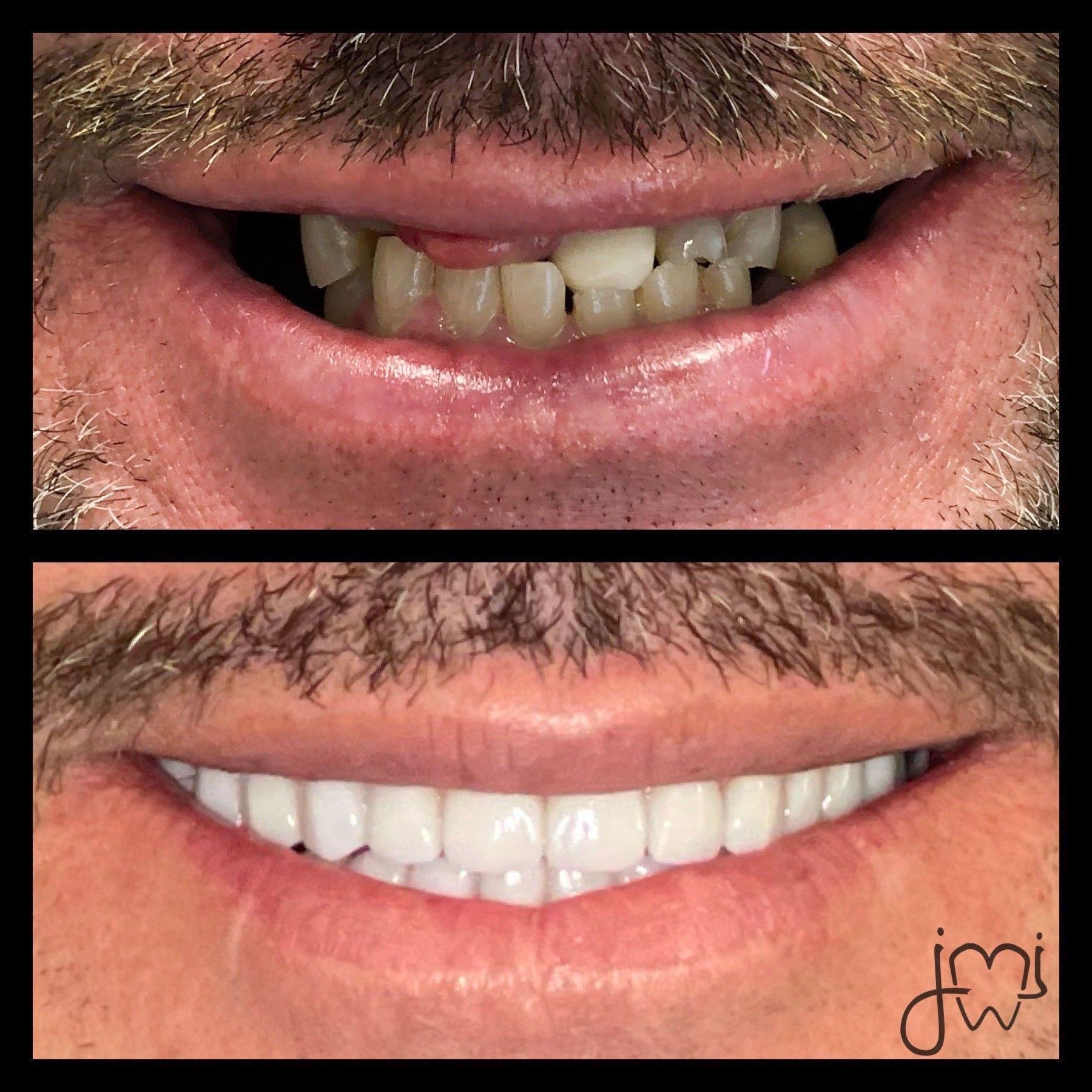 A before and after picture of a man 's teeth