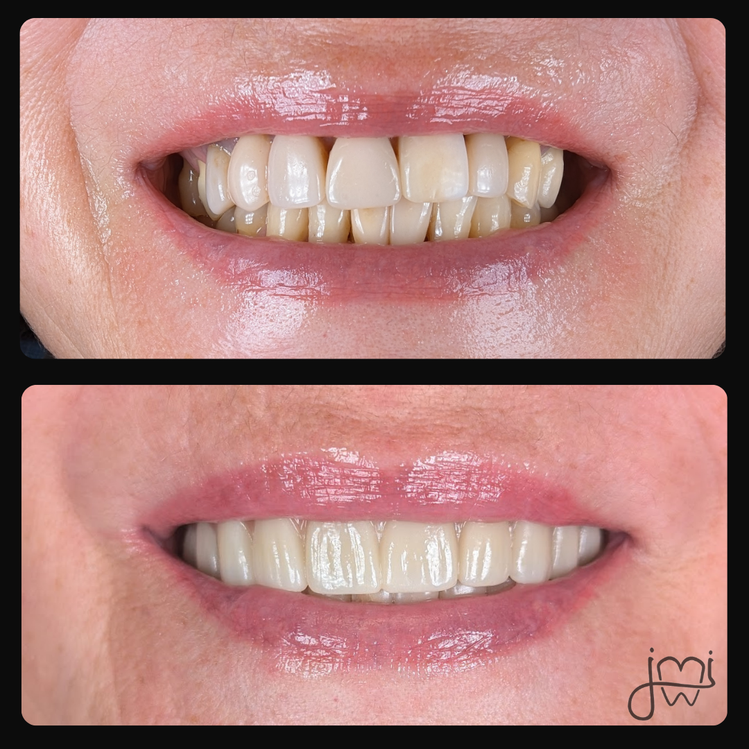 A before and after photo of a woman 's teeth
