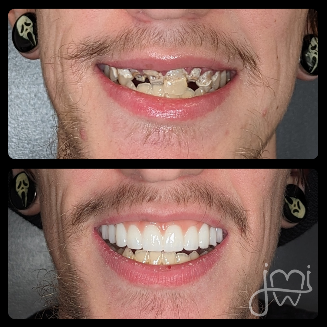 A before and after photo of a man 's teeth.