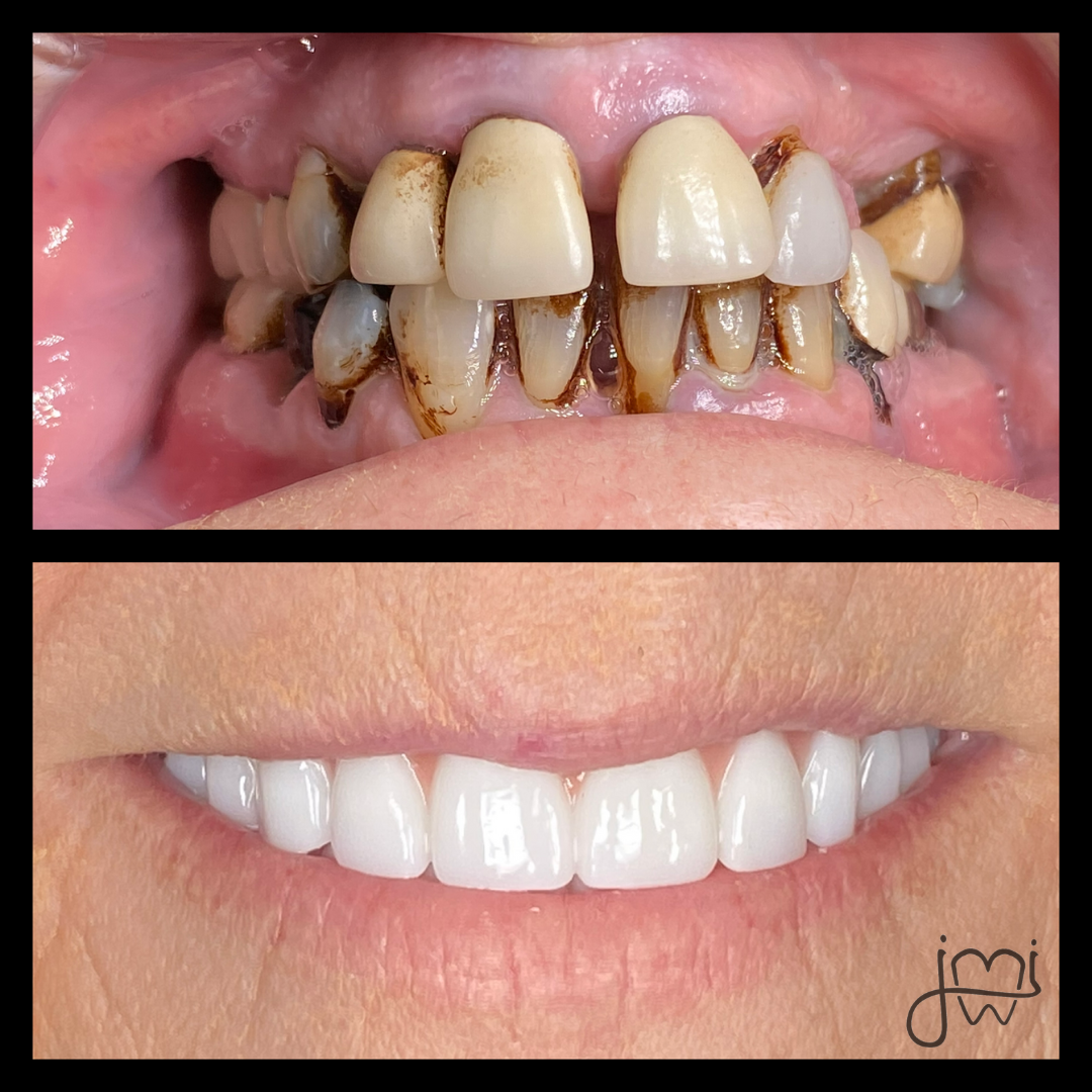 A before and after picture of a person 's teeth