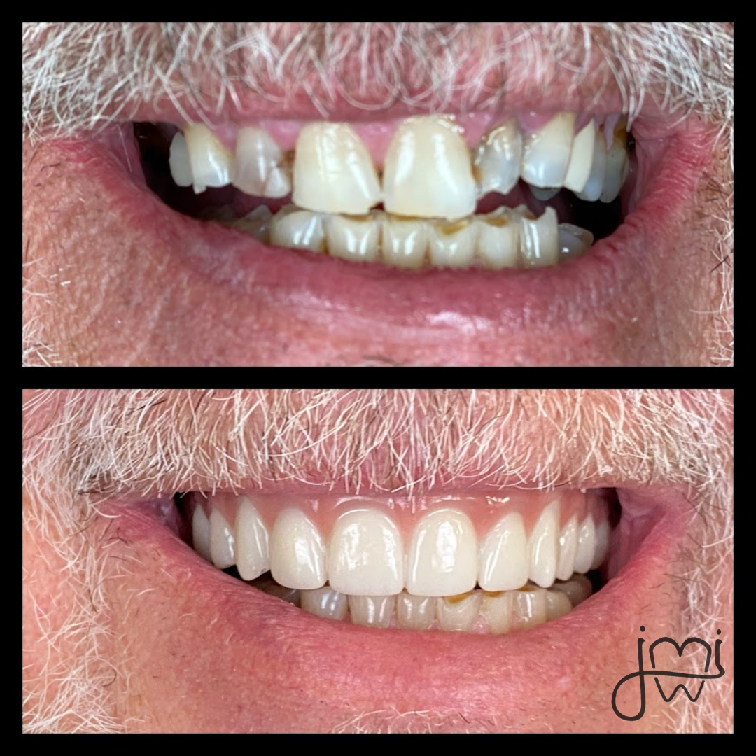 A before and after photo of a man 's teeth.