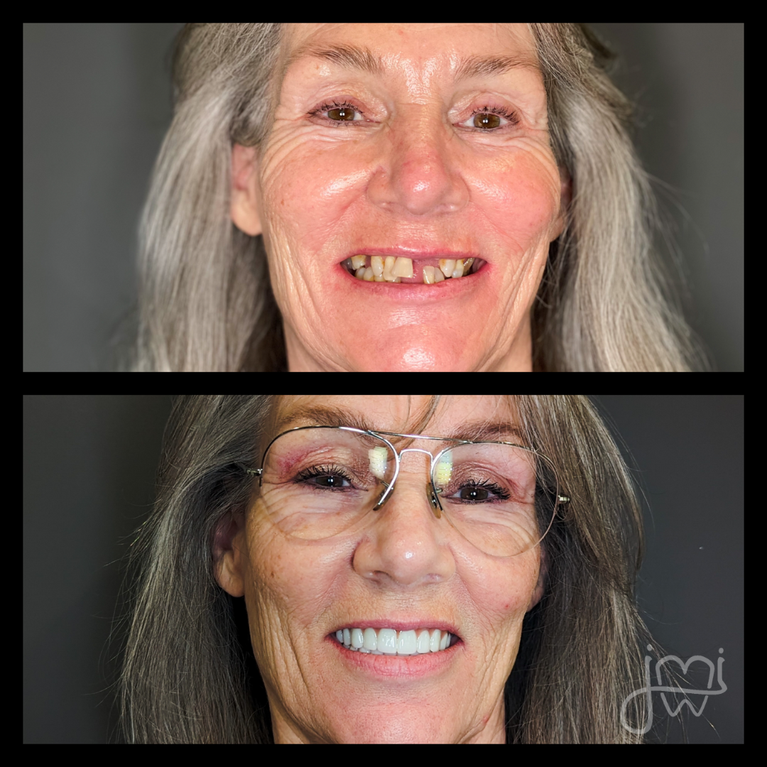 A before and after photo of a woman 's smile with glasses.