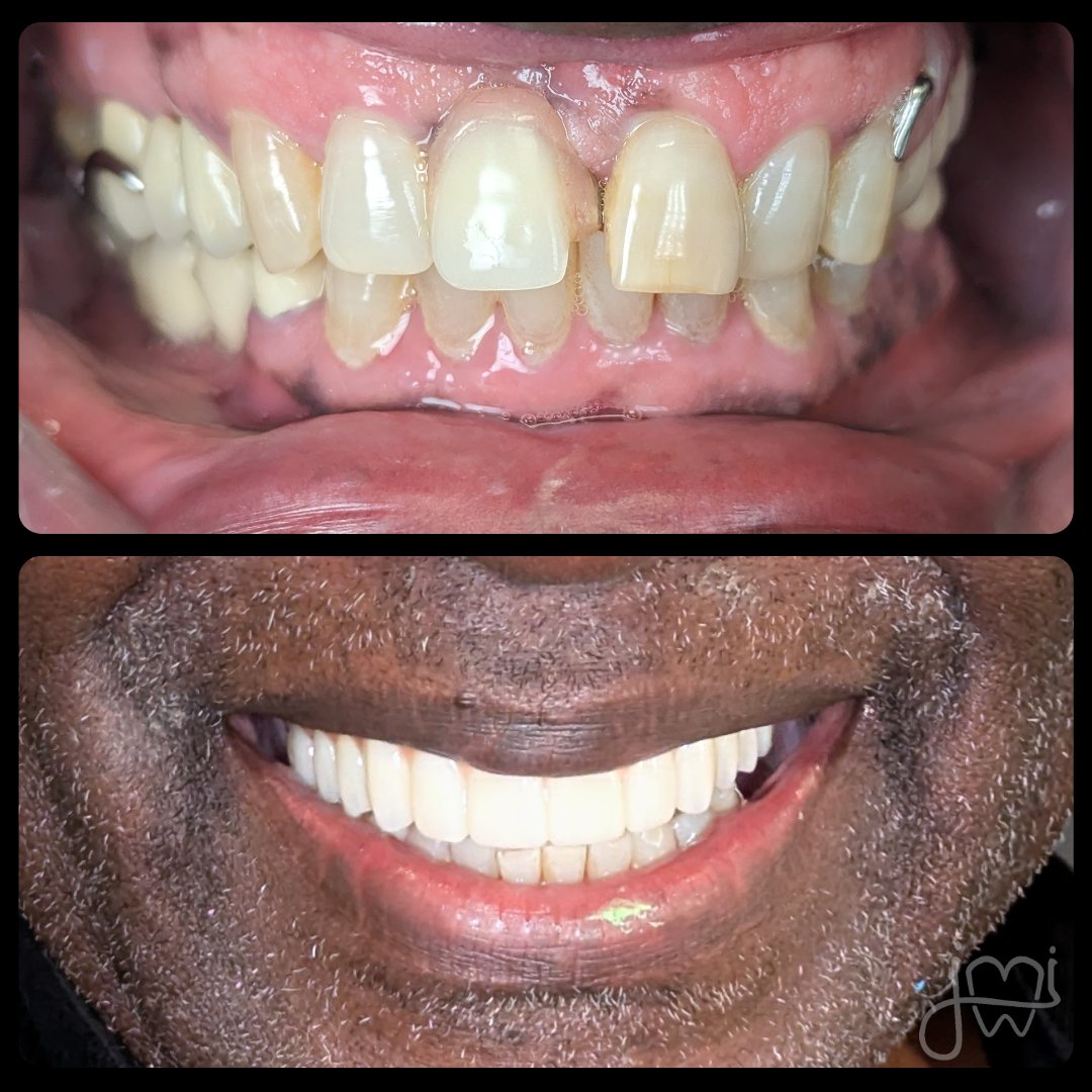 A before and after photo of a man 's teeth