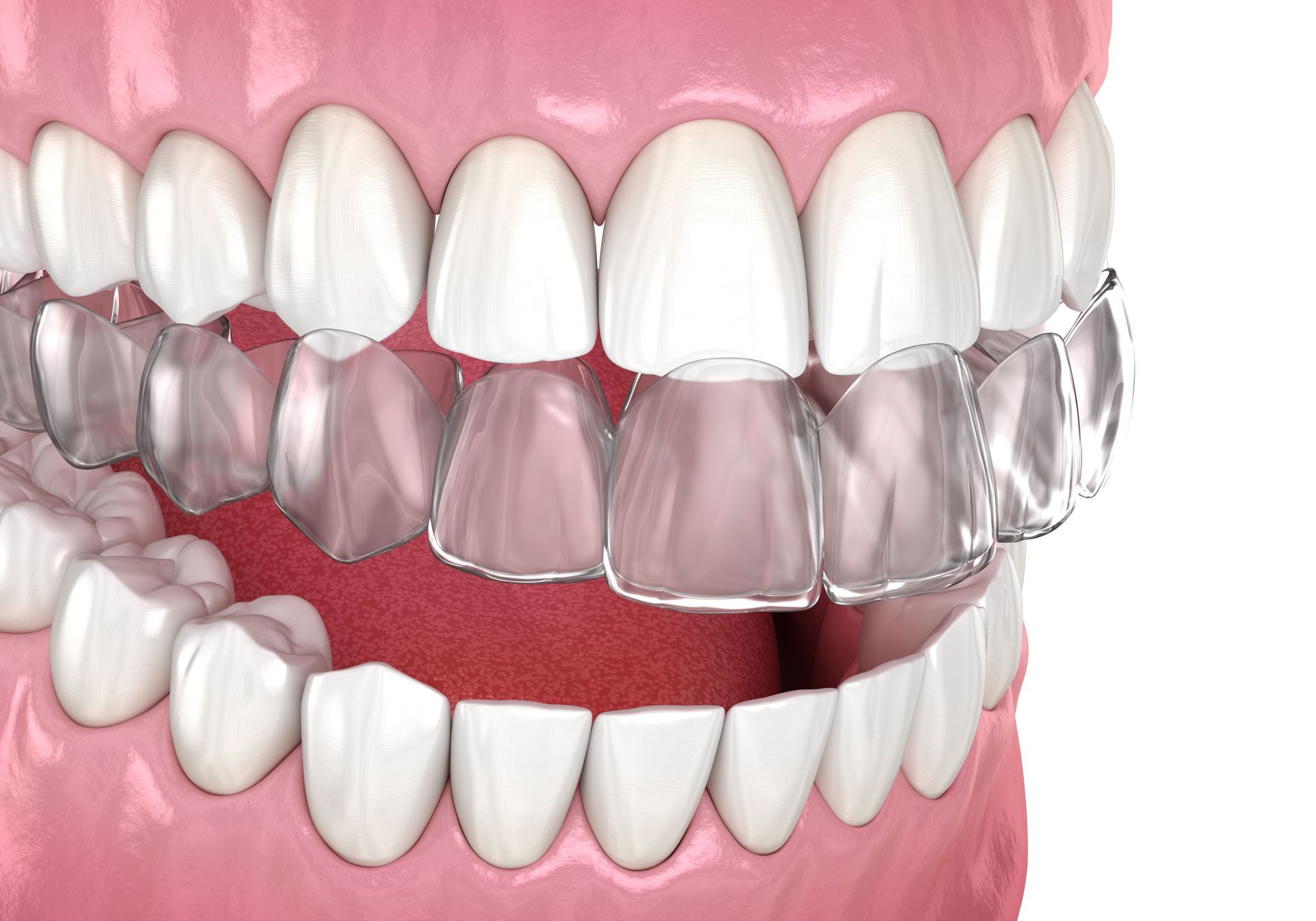 A close up of a person's teeth with clear braces