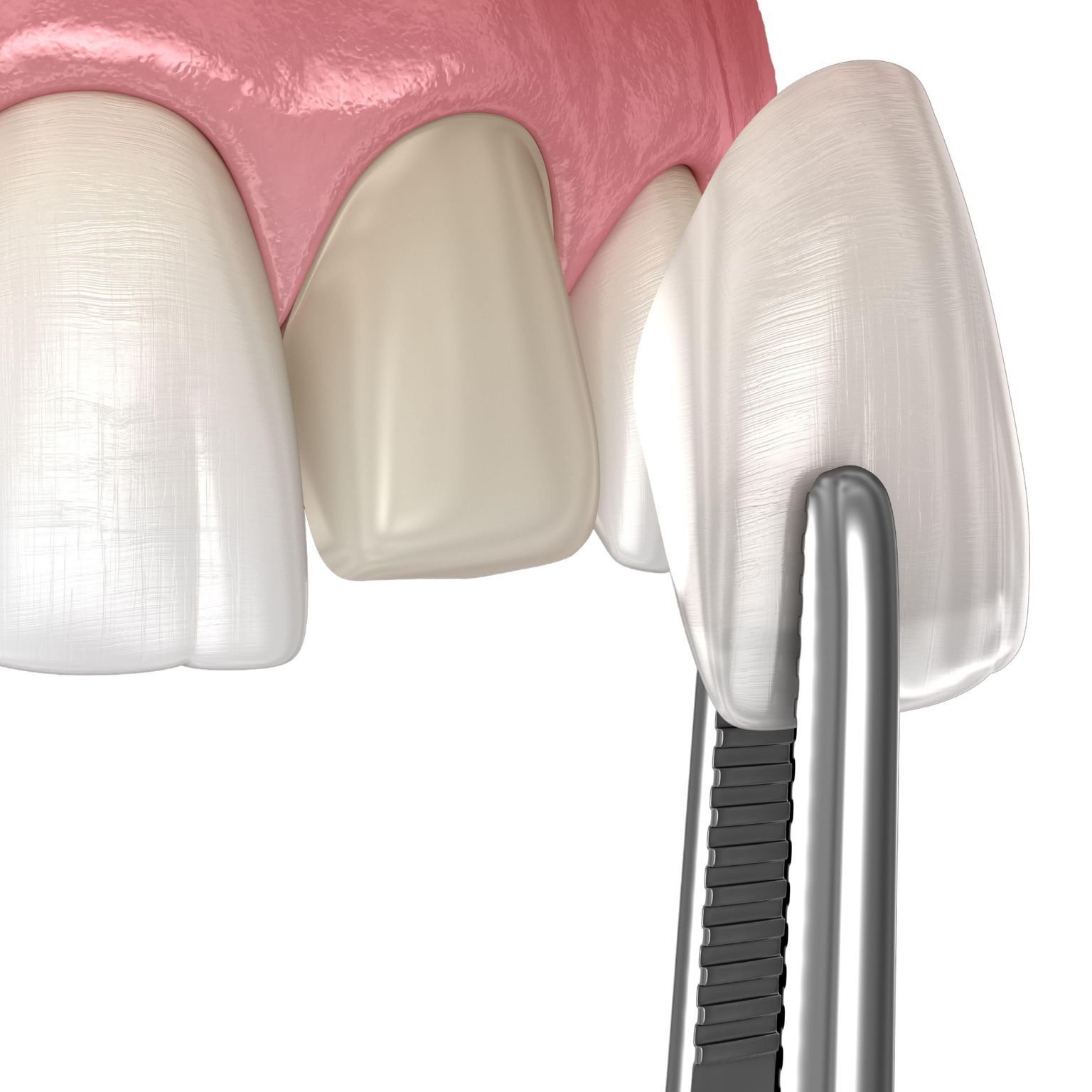 A close up of a tooth with a dental crown on it