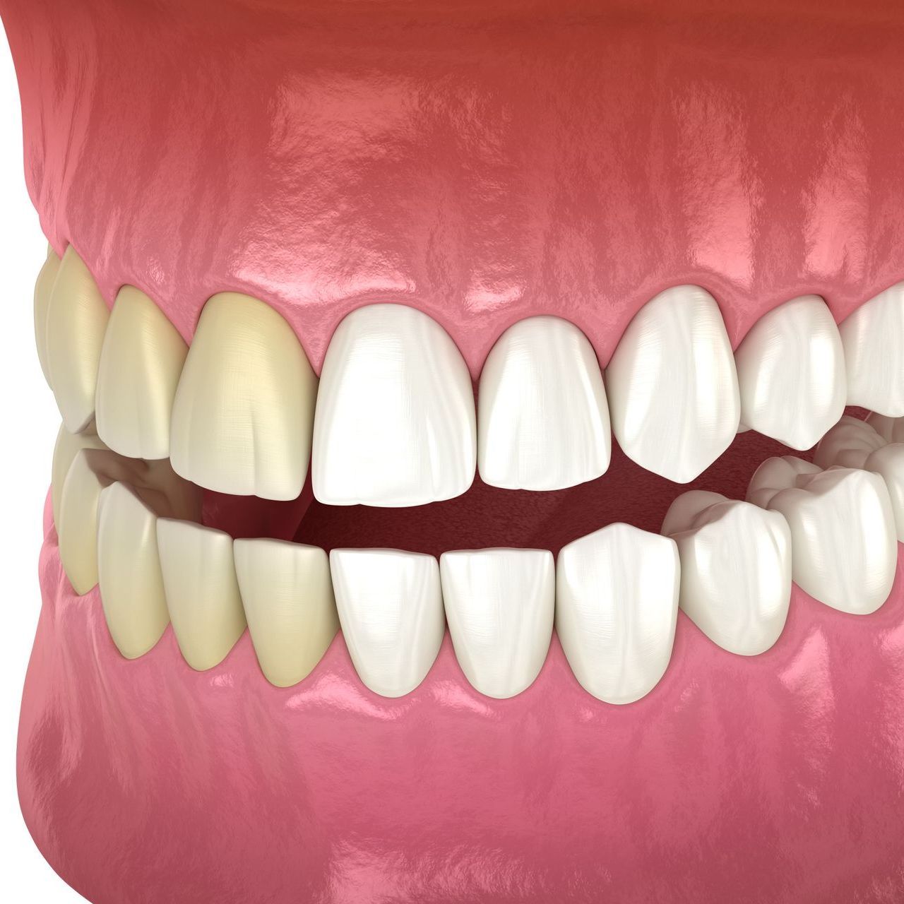 A close up of a model of a mouth with white teeth