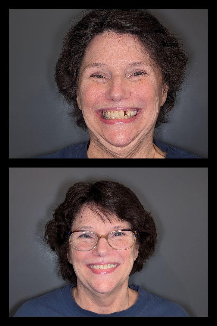 Before and after photos of a woman smiling, top photo showing her bad teeth, bottom photo showing improved teeth.