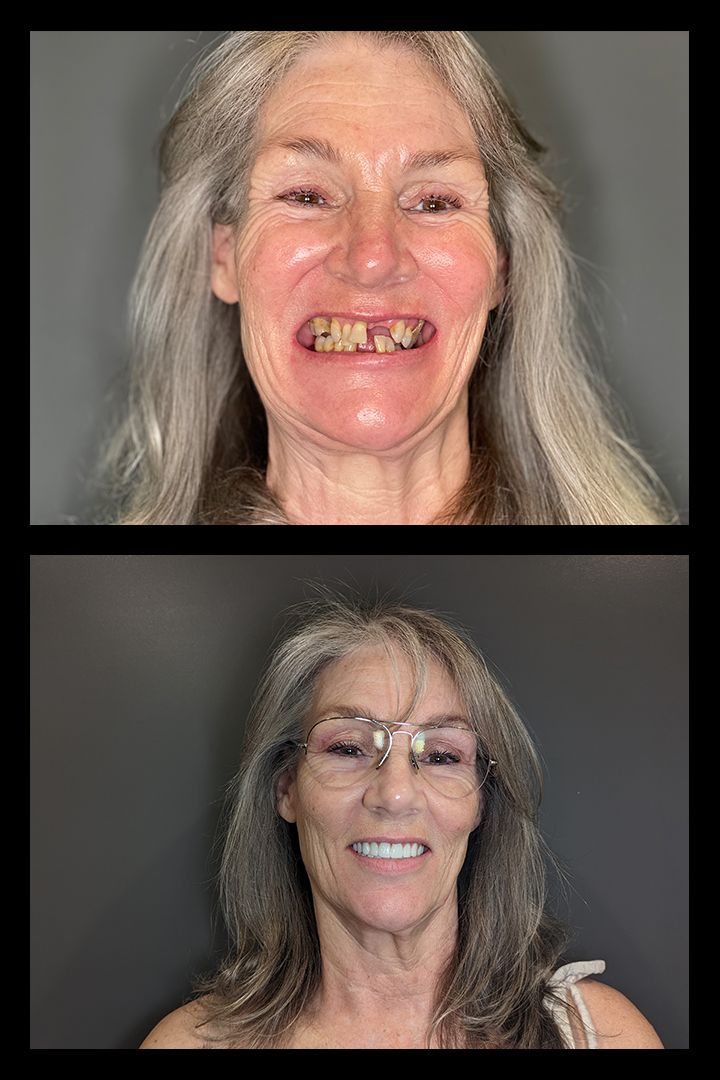 Before and after photos: Woman with discolored teeth smiles, then smiles with new, white teeth.