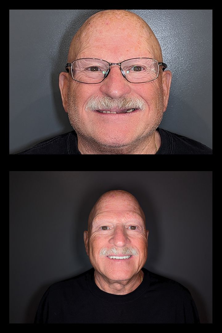 Top: man with glasses and missing teeth. Bottom: same man with a full, white smile.