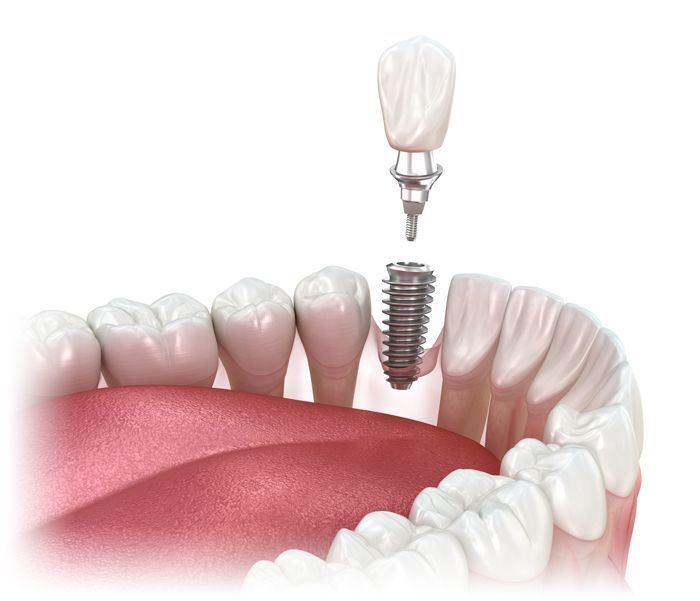 A single dental implant is being placed in a person 's mouth.