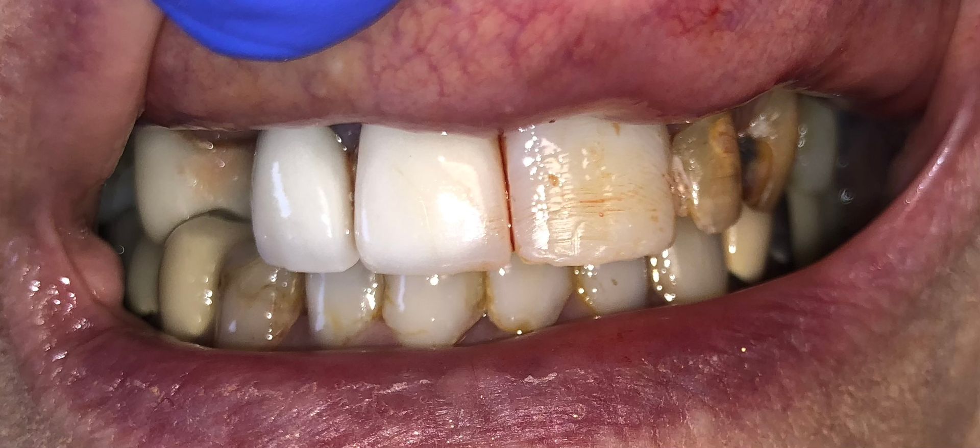 A close up of a person 's teeth with a blue glove on.