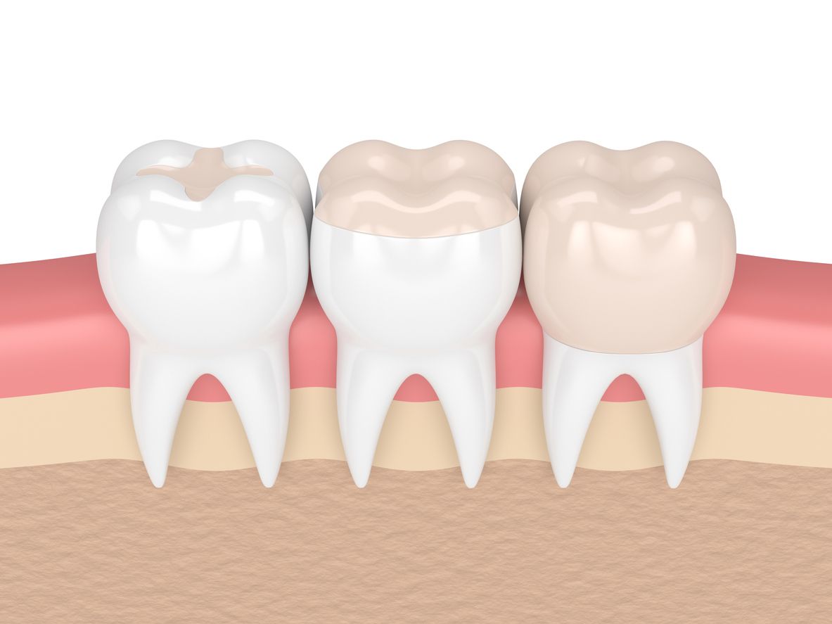 A 3d rendering of a row of teeth with fillings in them.