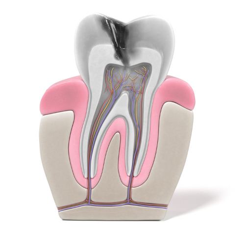 A model of a tooth with a cavity in it.