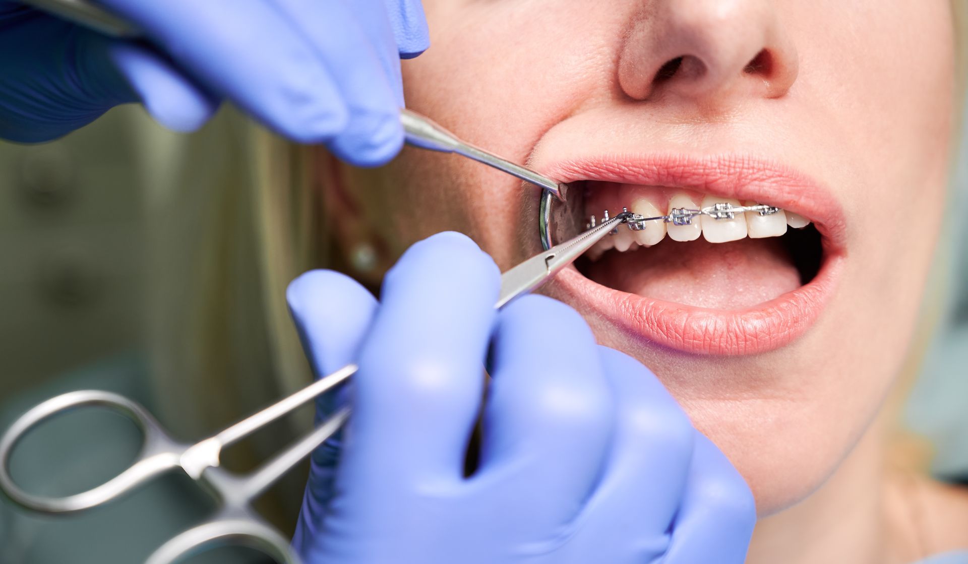 A person's mouth with braces being worked on with dental tools by someone wearing blue gloves.