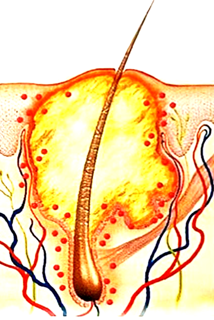 Acne: scomparsa infiammazione, luce blu