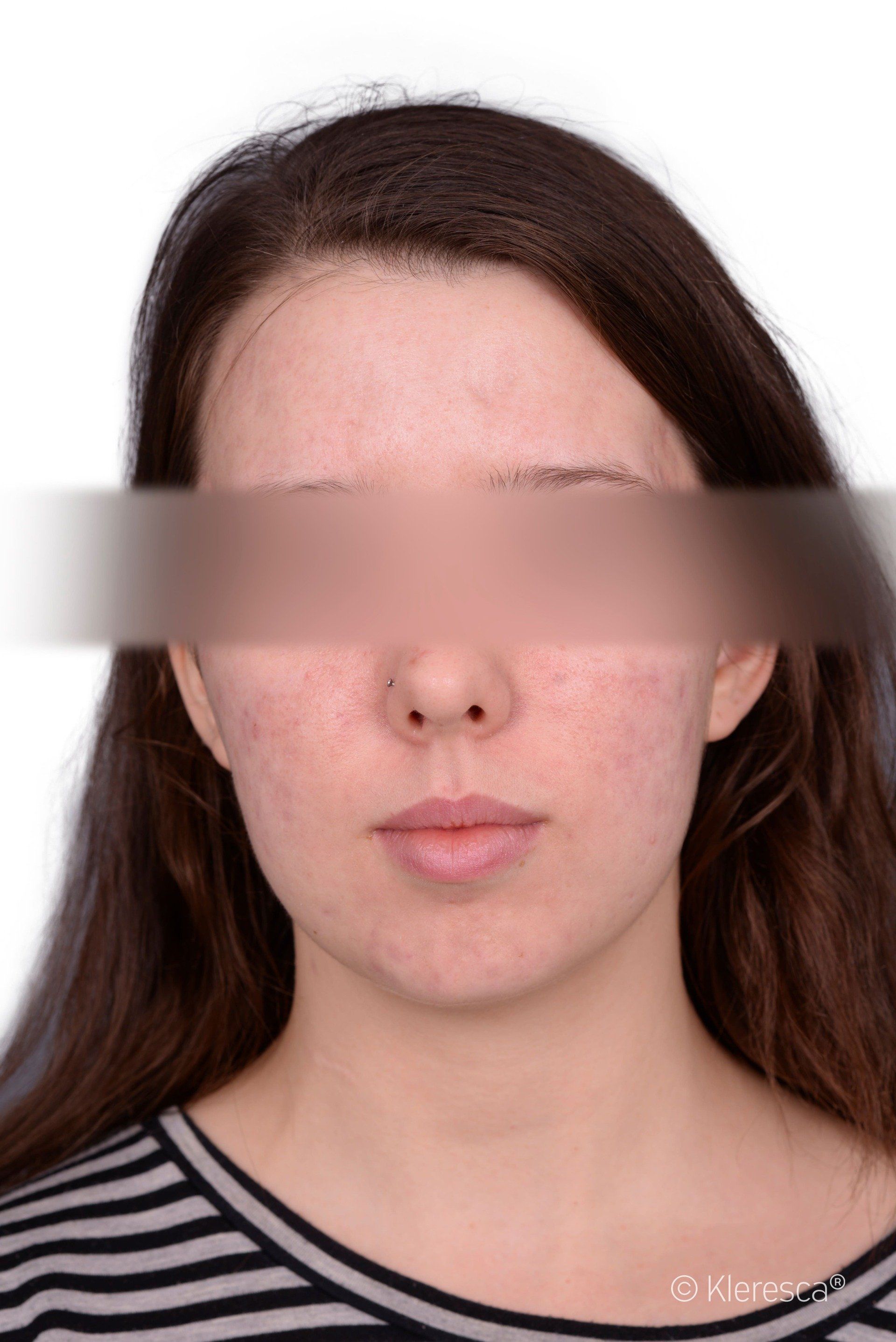 acne dopo il trattamento