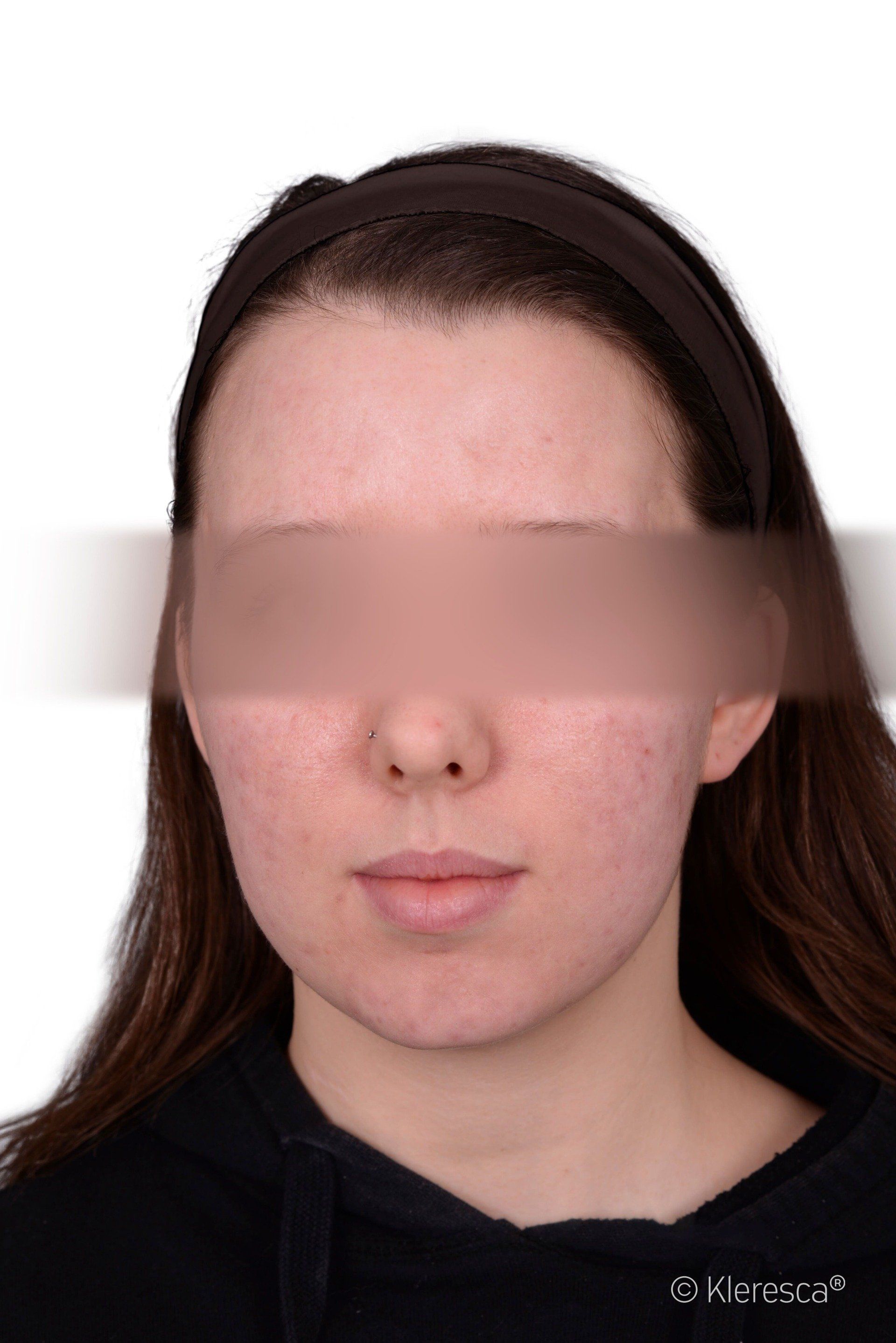 acne dopo il trattamento