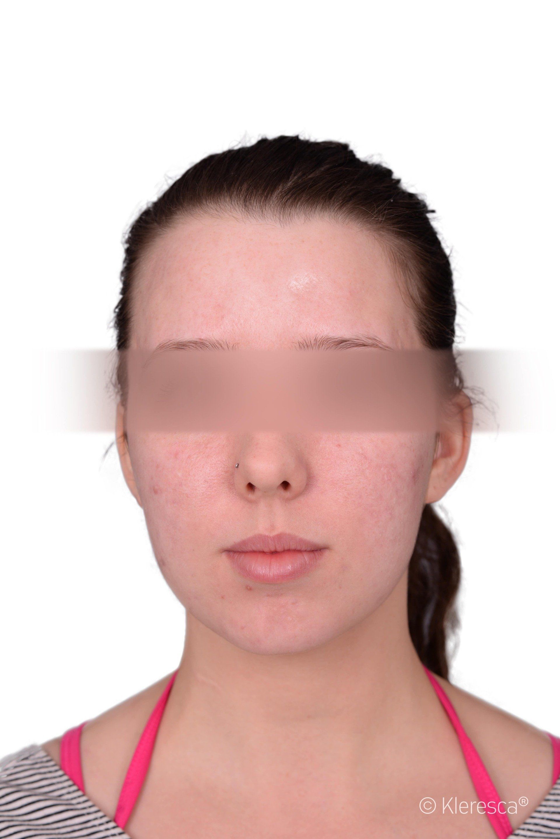 acne dopo il trattamento