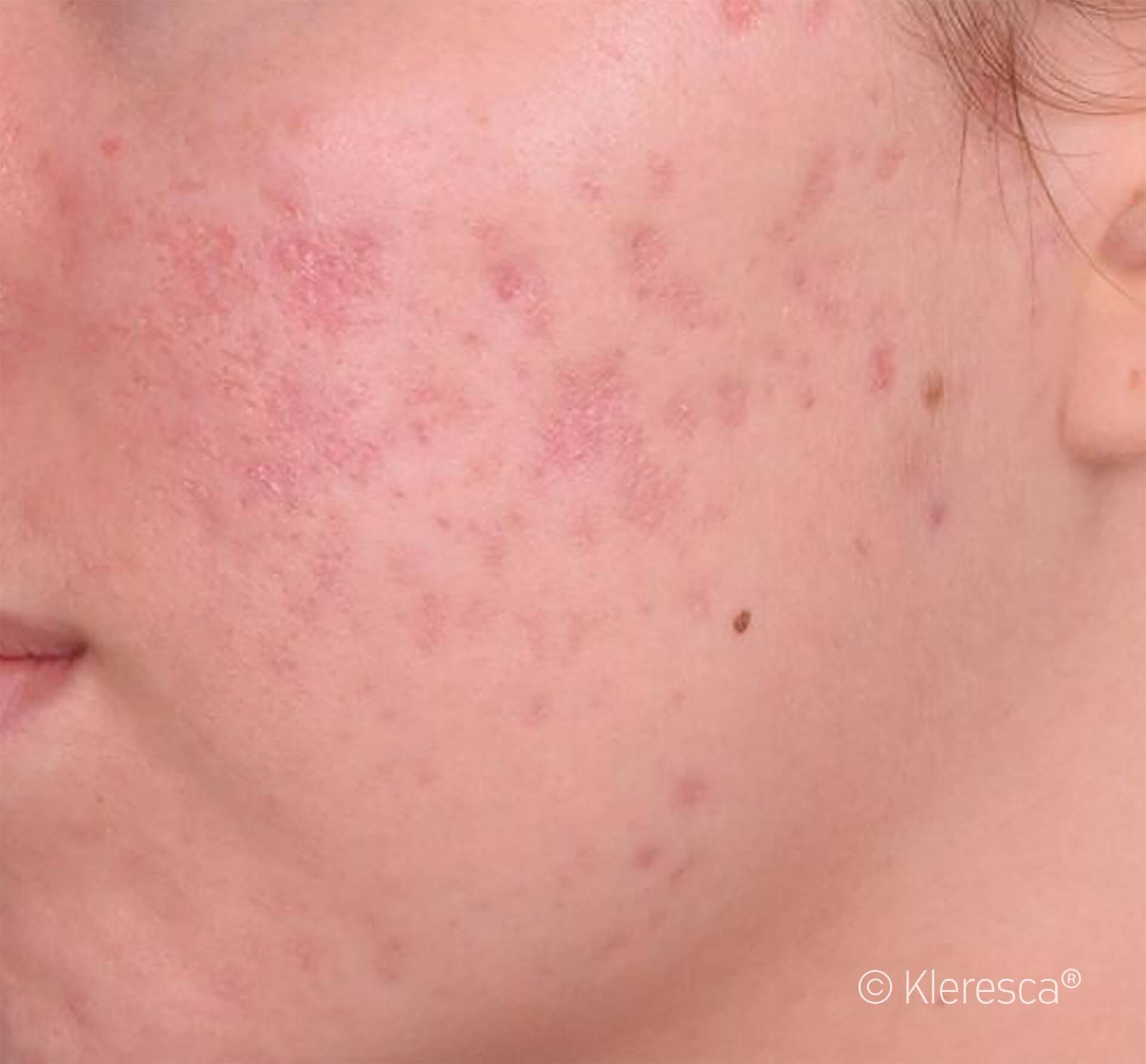 acne che sta per sparire