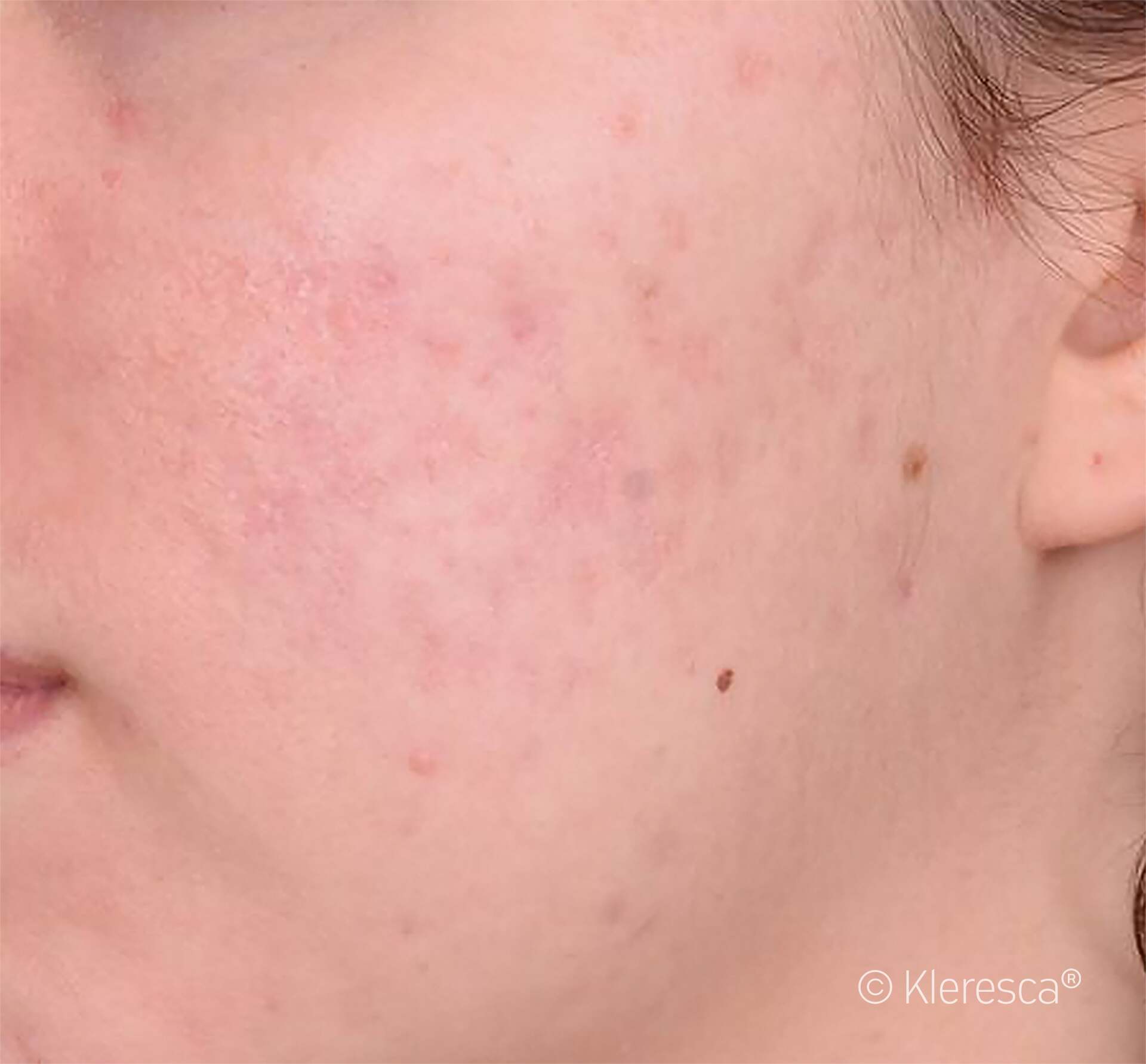acne eliminazione