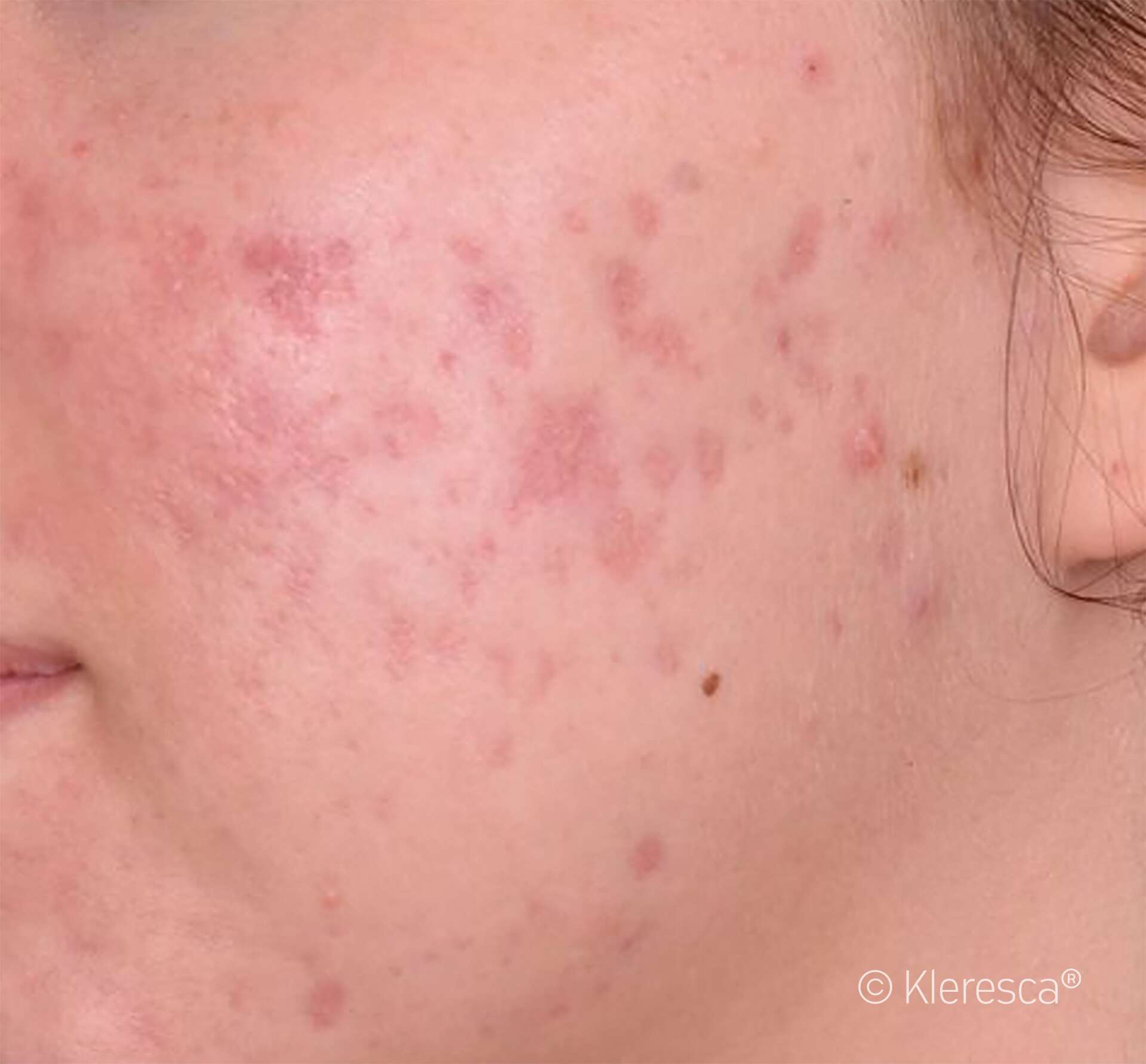 acne che sta per sparire