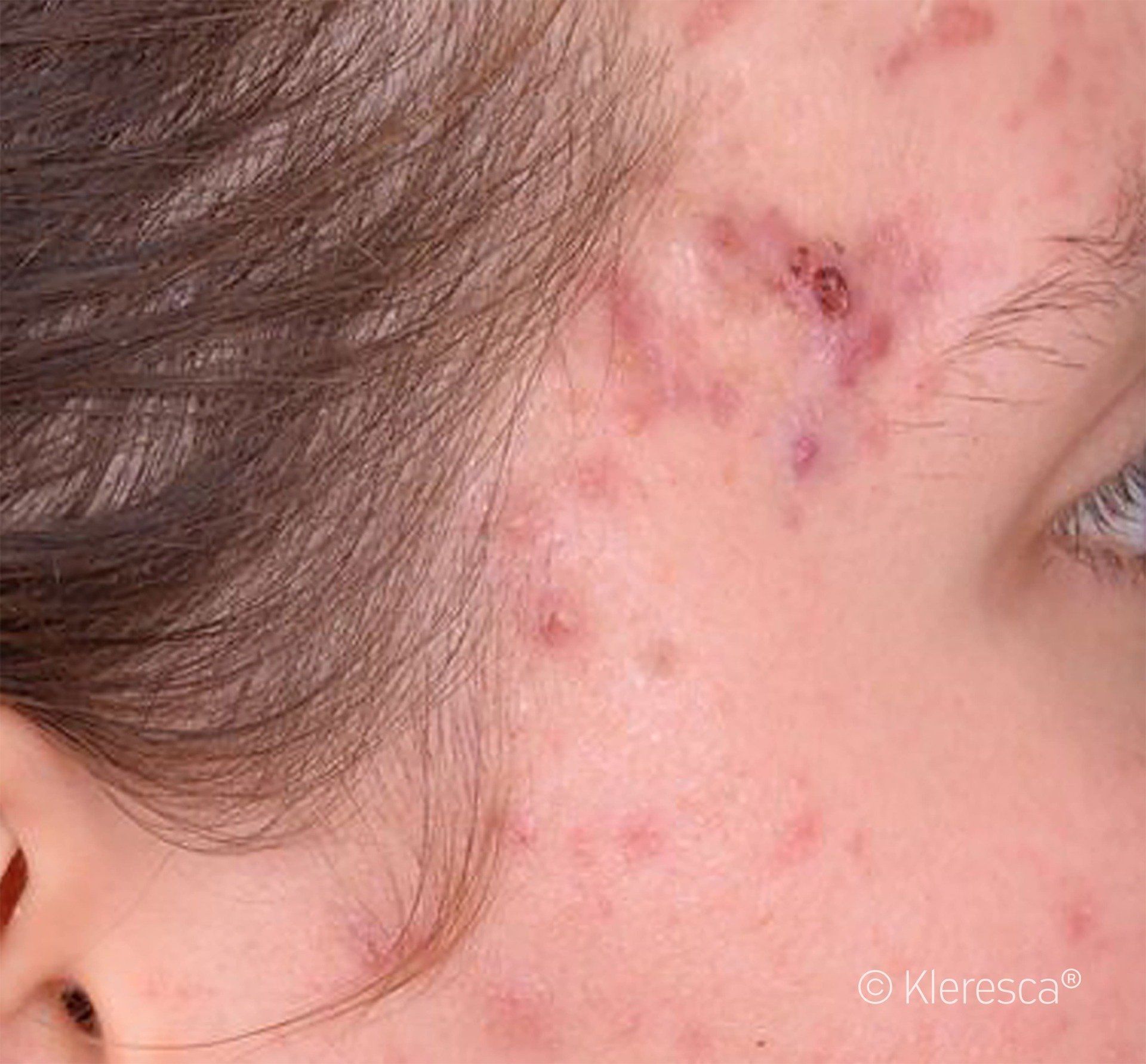 acne prima del trattamento