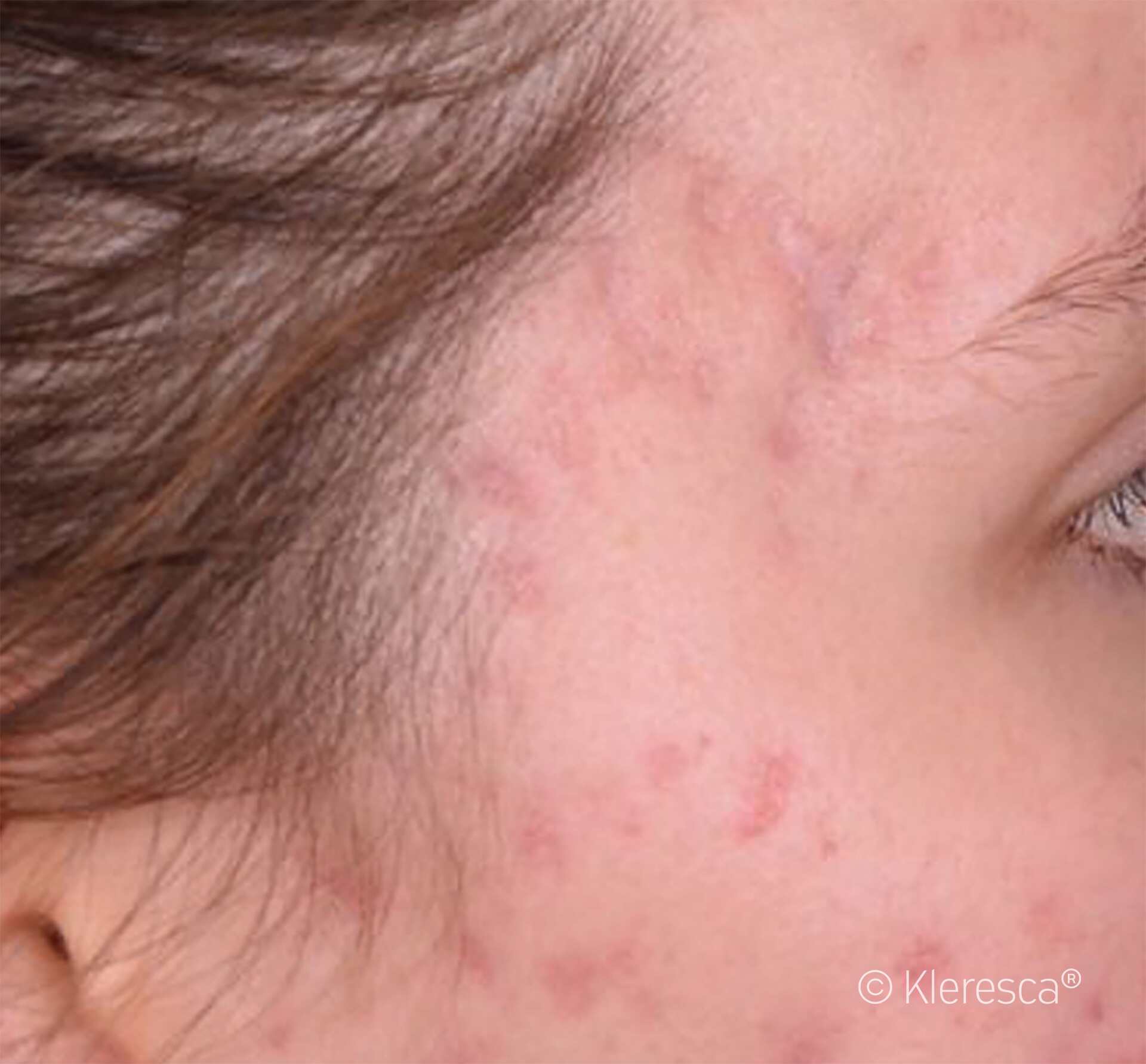 acne che sta per sparire