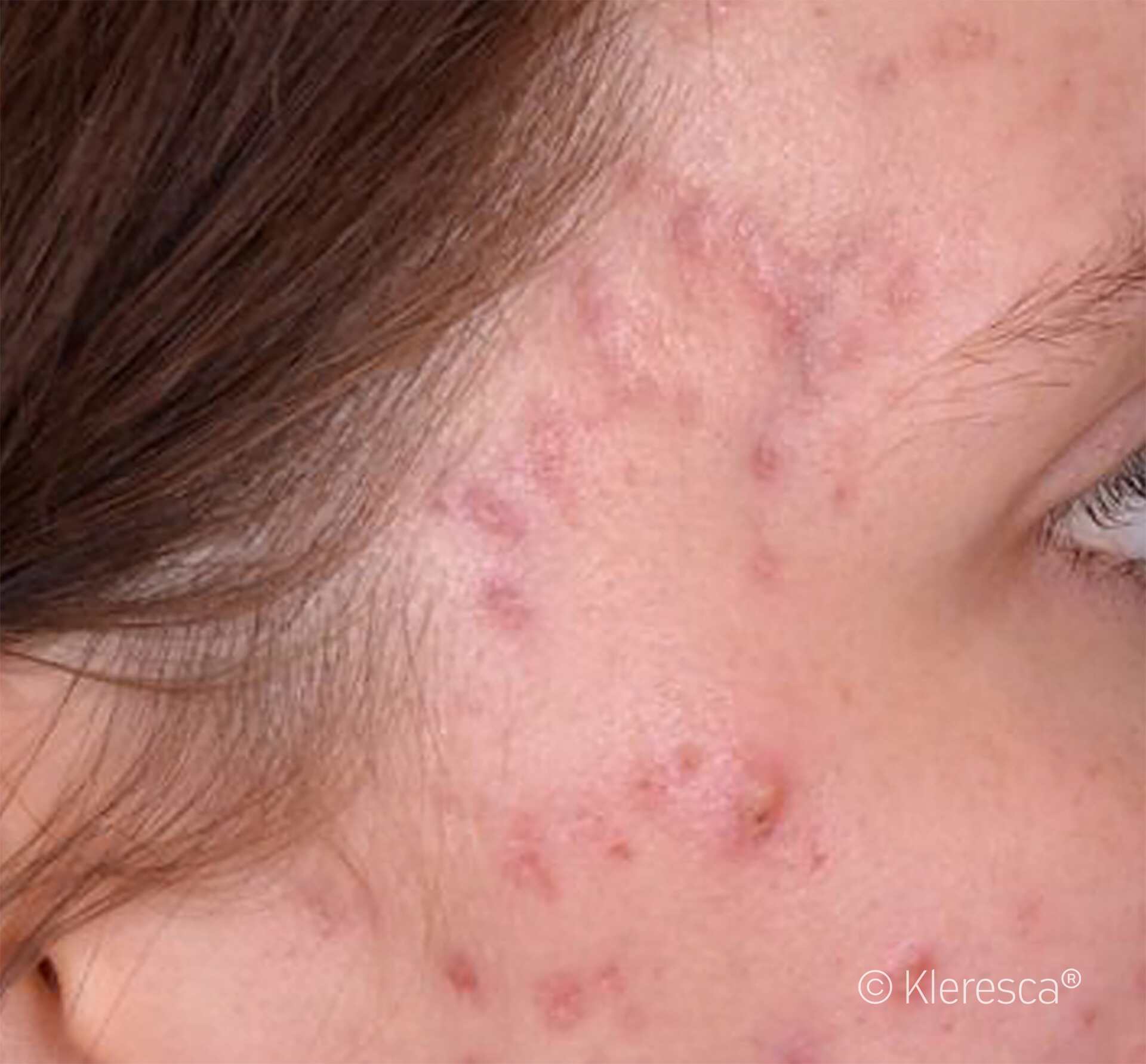 acne che sta per sparire