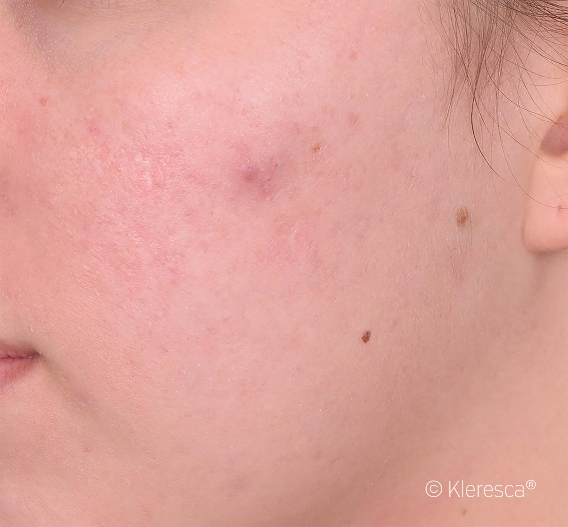 acne sparita dopo oil trattamento