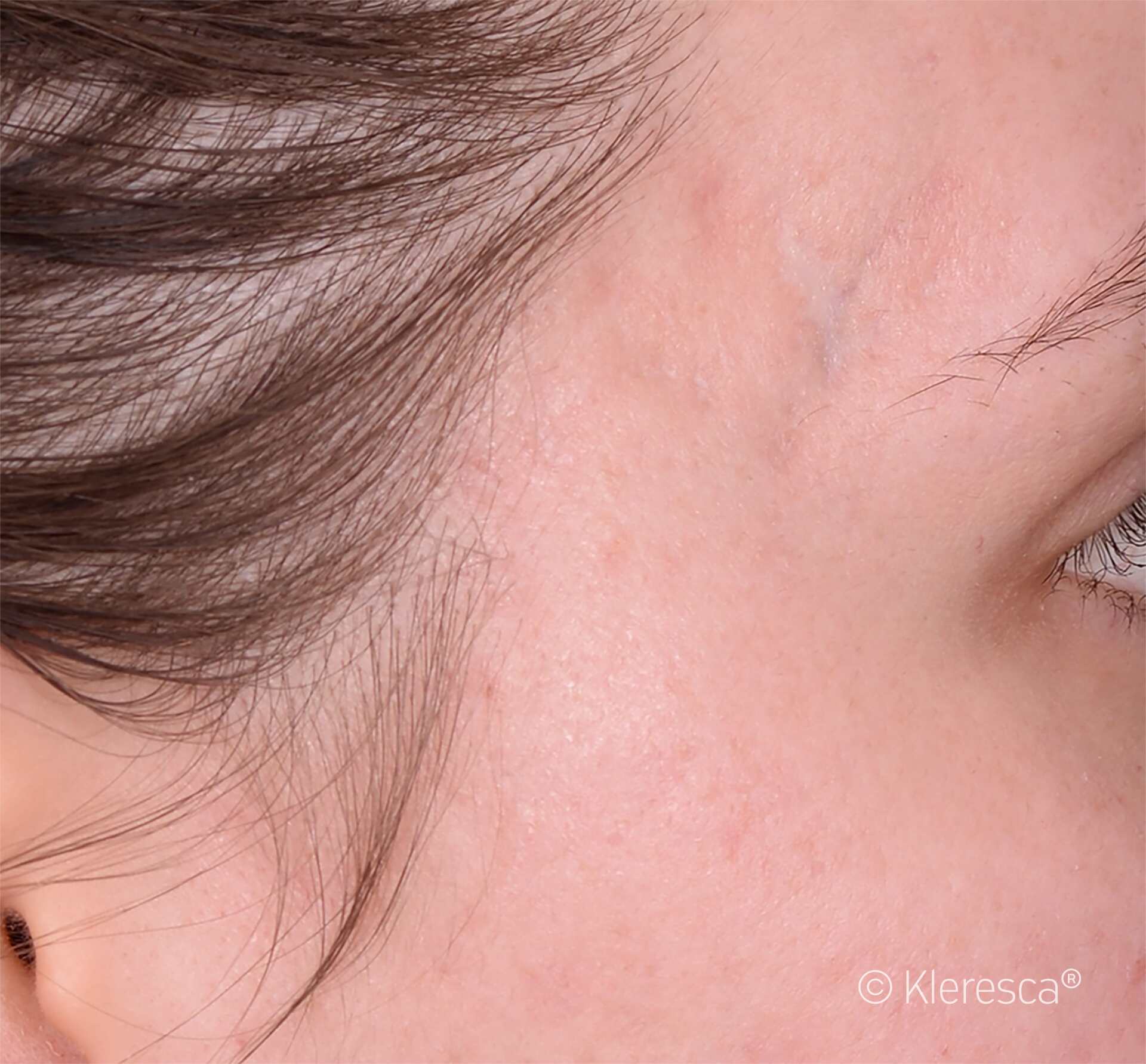 acne sparita dopo oil trattamento