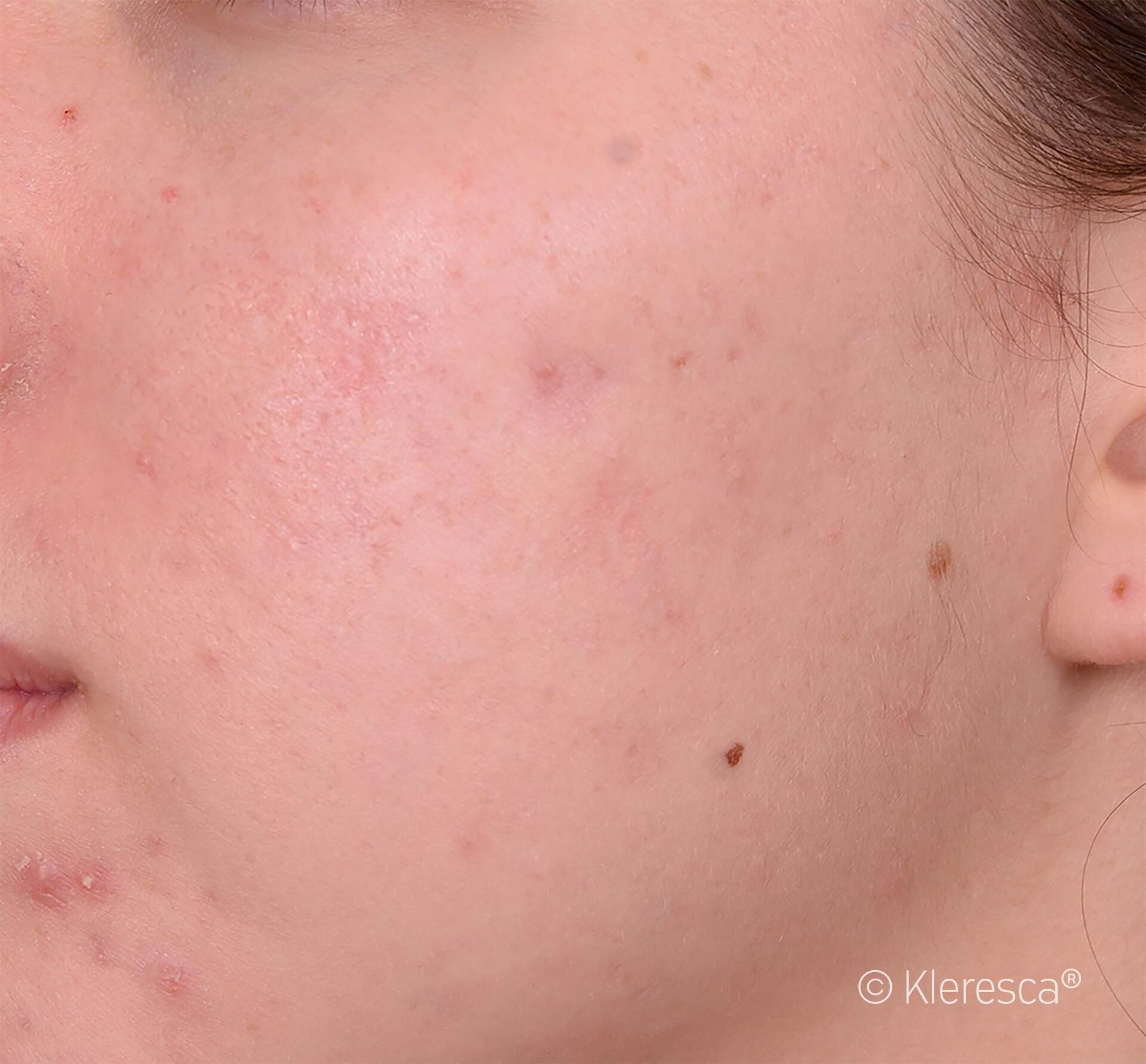 acne dopo il trattamento