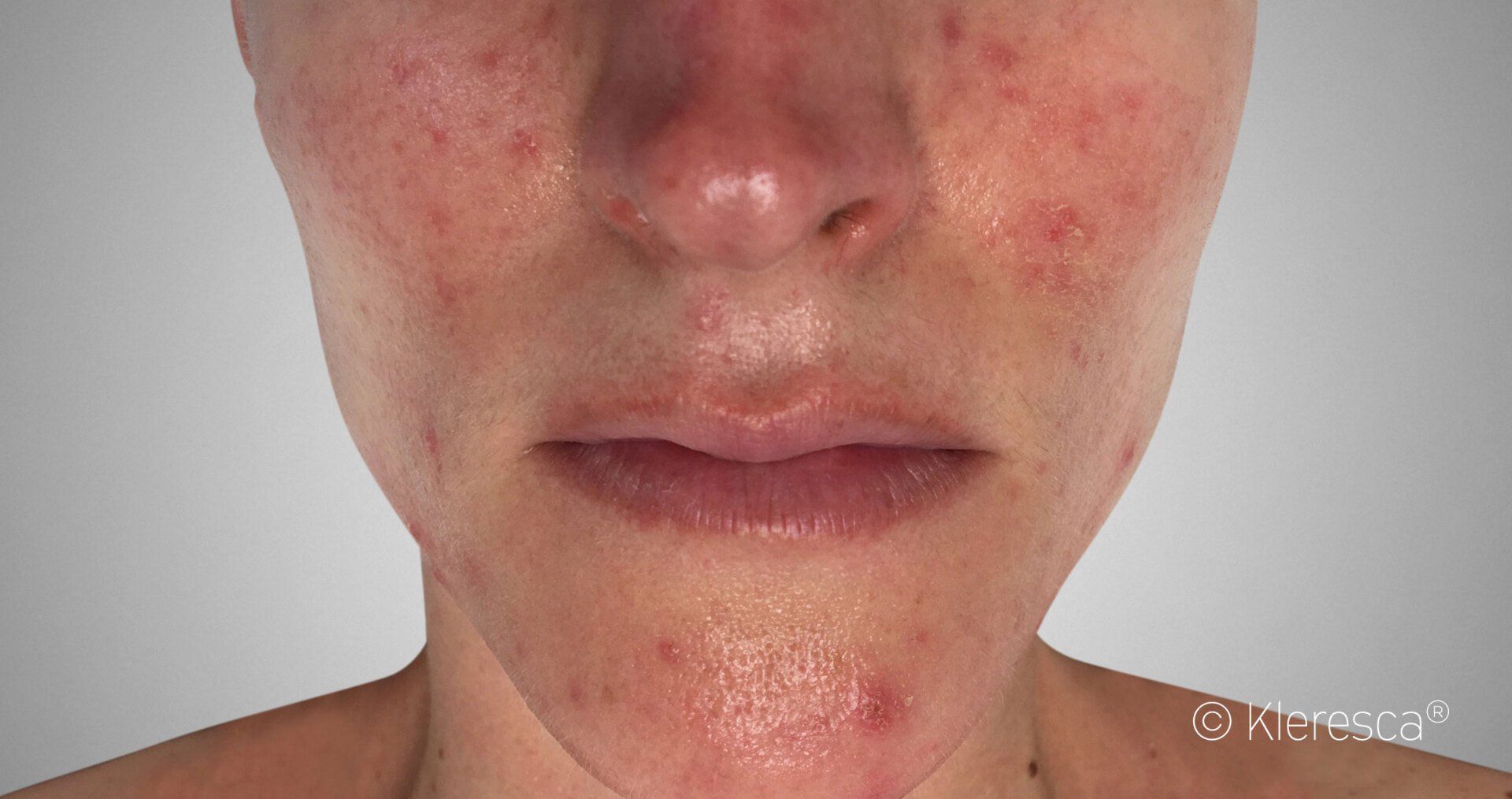 rosacea