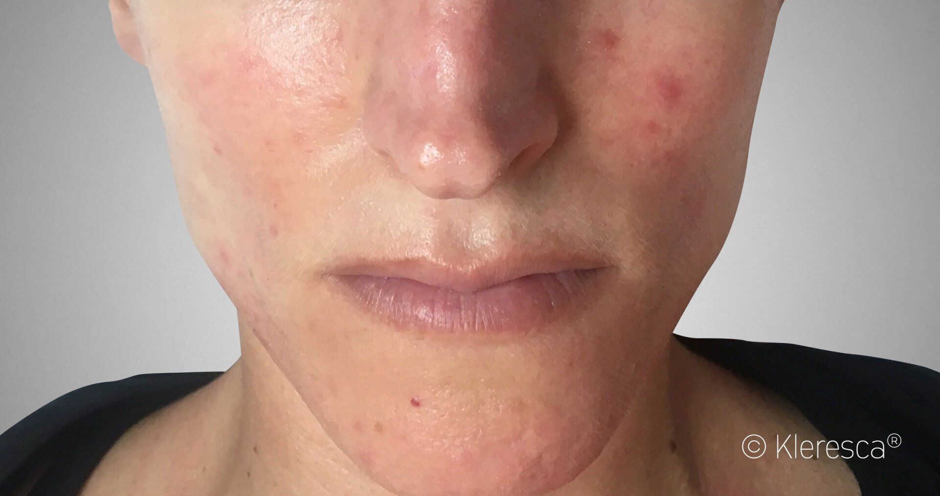 guarigione da rosacea