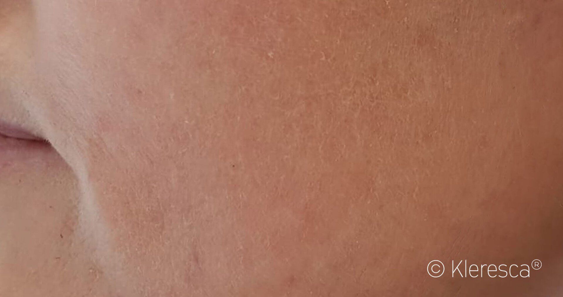 cura rosacea