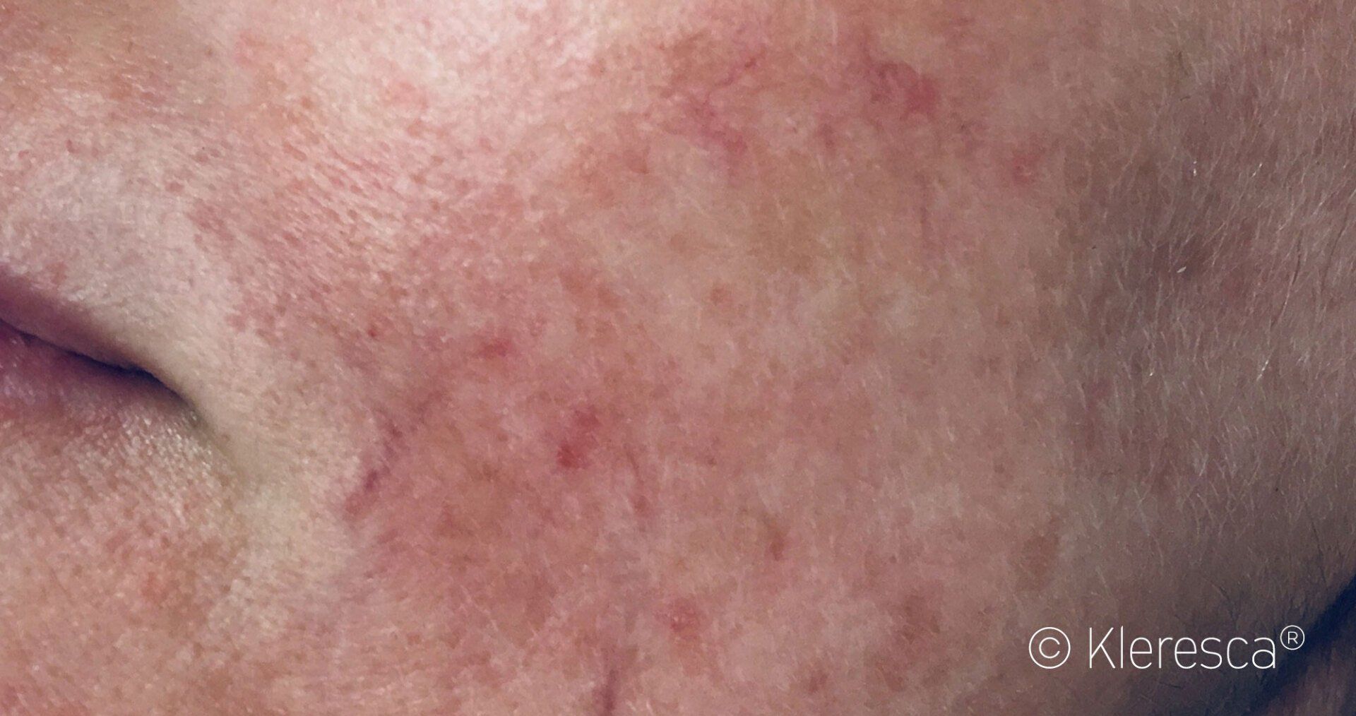 fase iniziale trattamento rosacea
